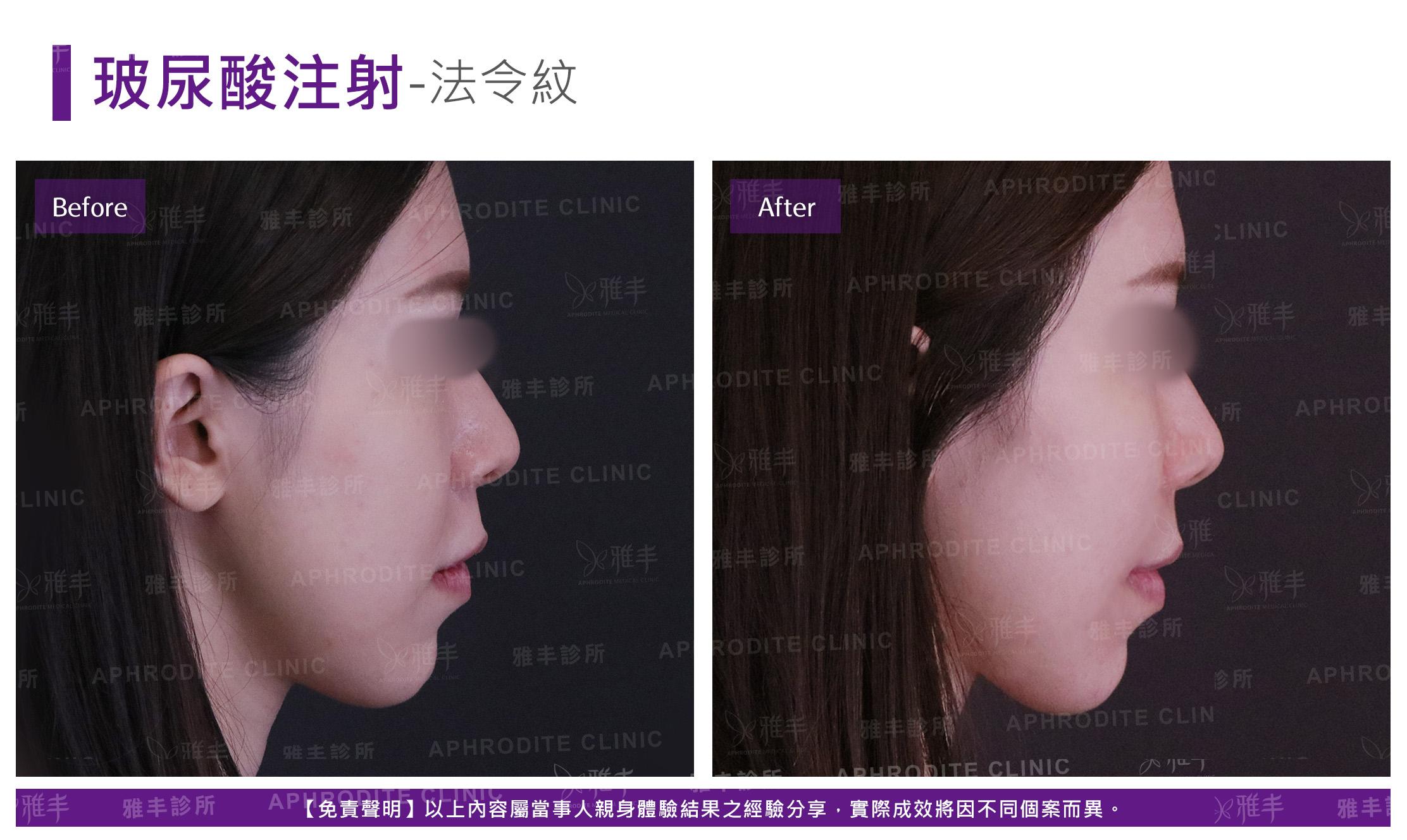 玻尿酸注射-case07-R.jpg