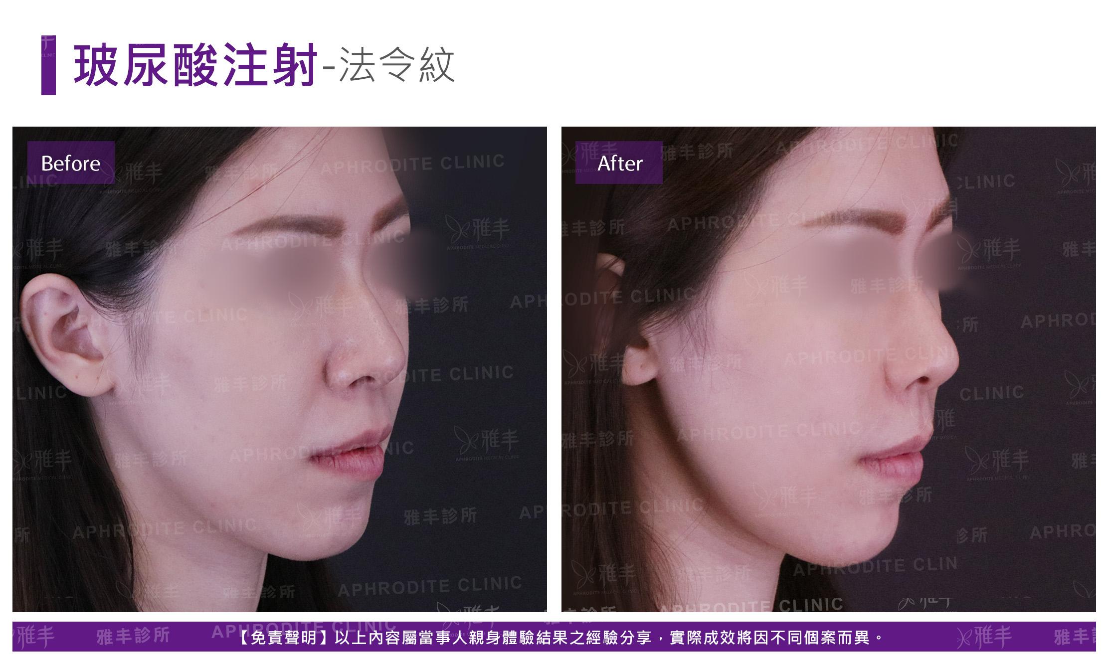 玻尿酸注射-case07-R45.jpg