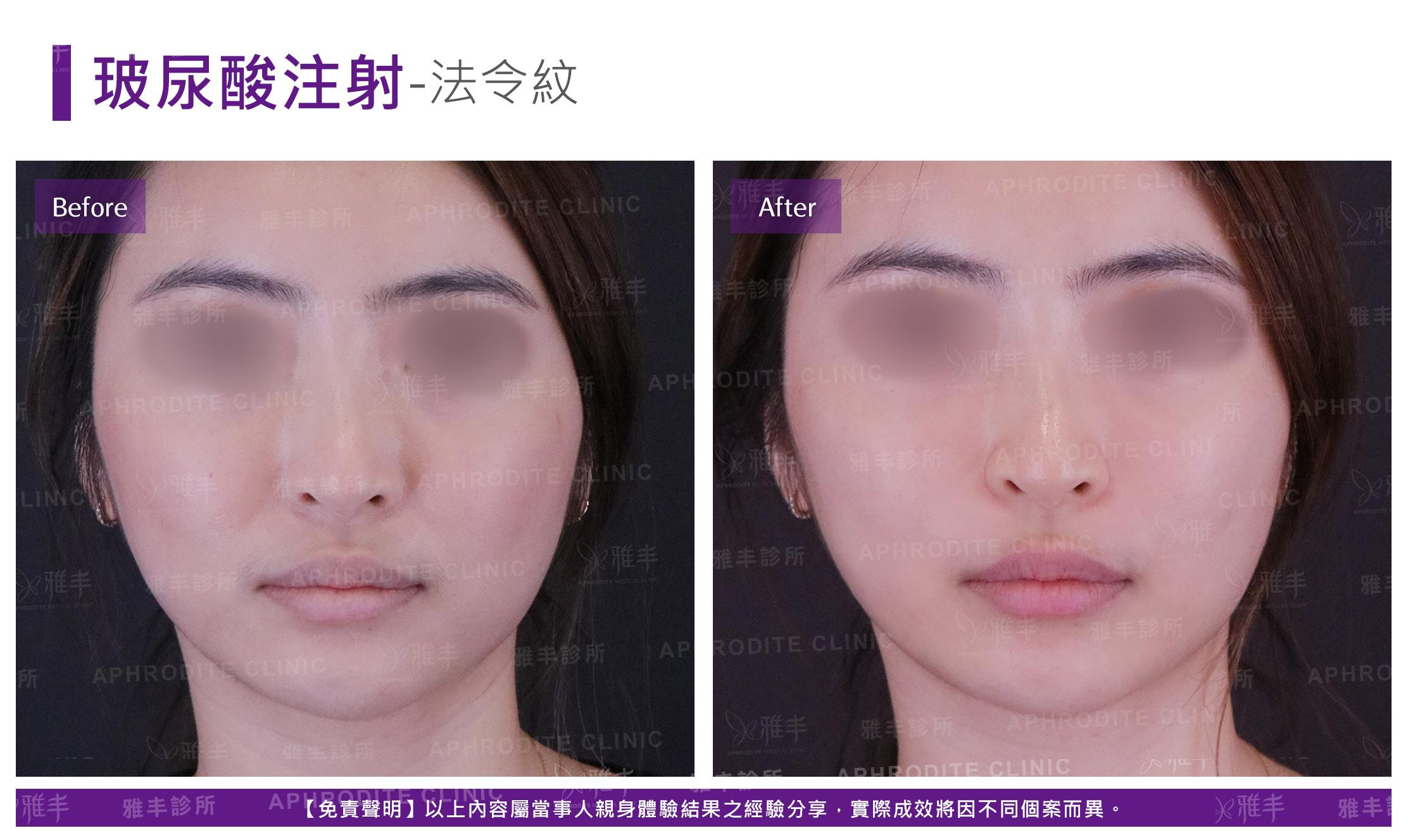 玻尿酸注射-case08-F.jpg