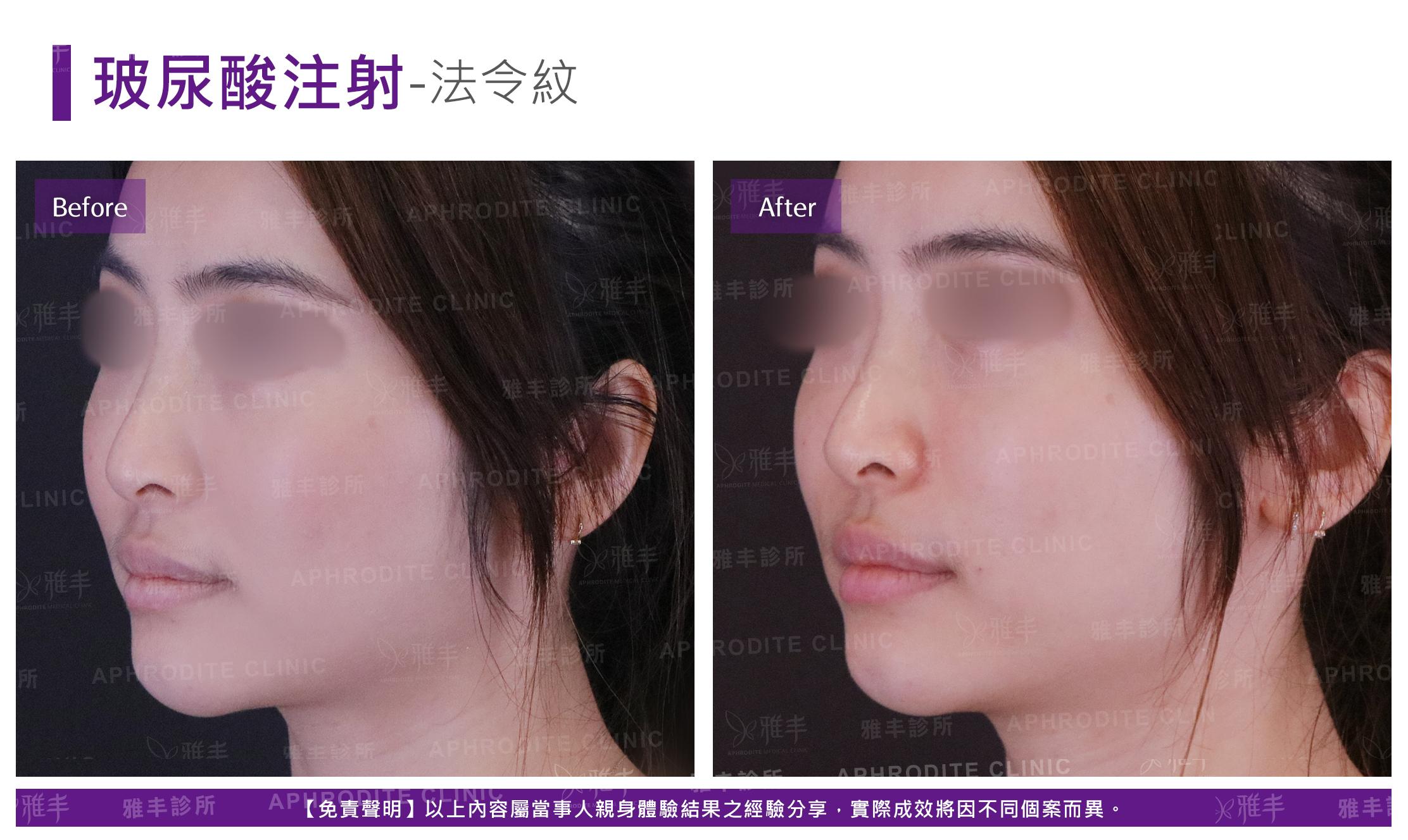 玻尿酸注射-case08-L45.jpg