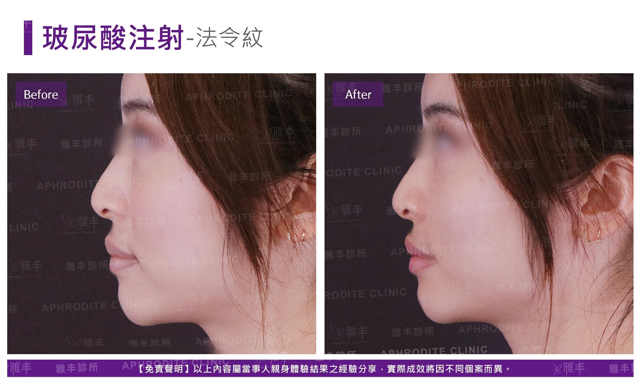 玻尿酸注射-case08-L90.jpg