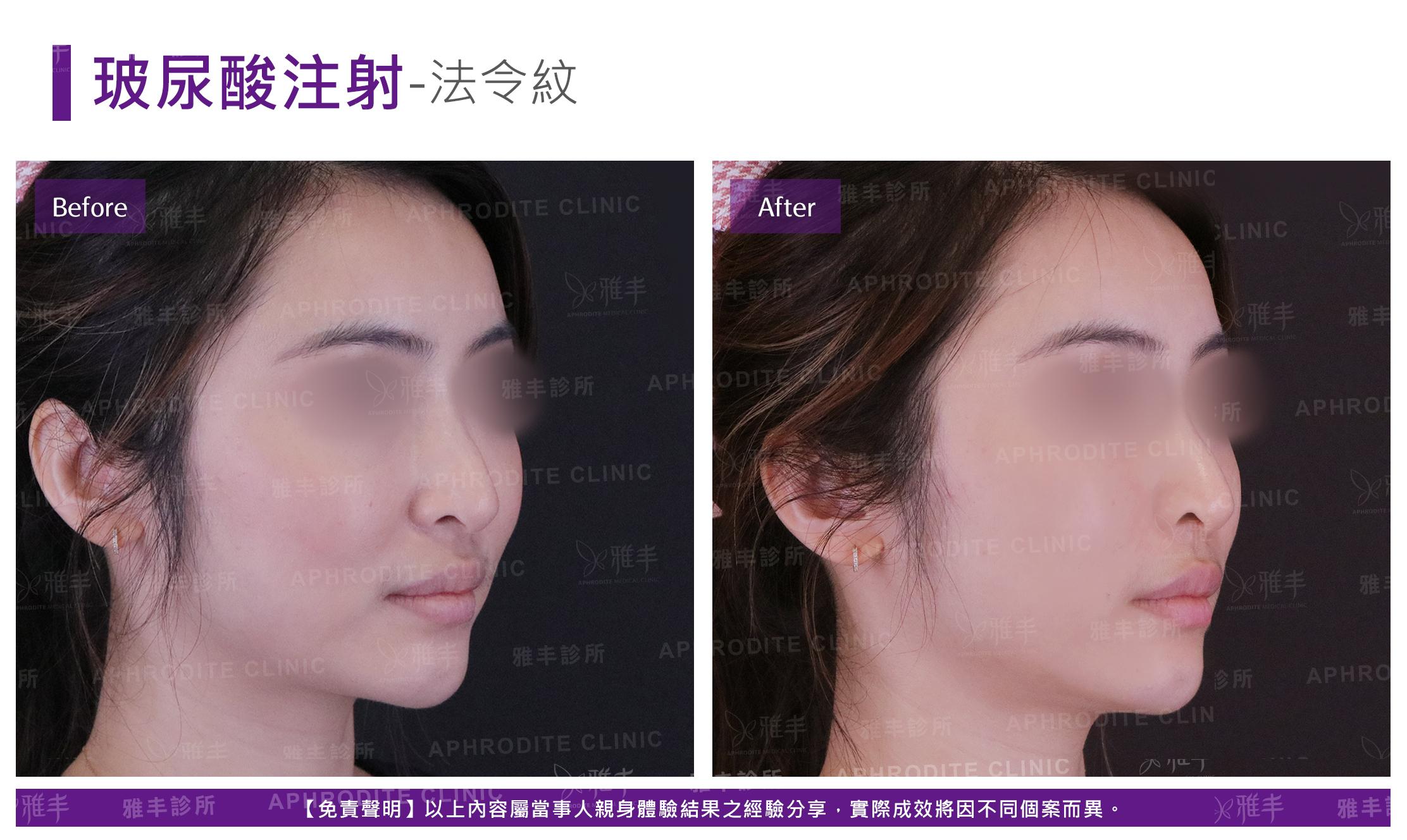 玻尿酸注射-case08-R45.jpg