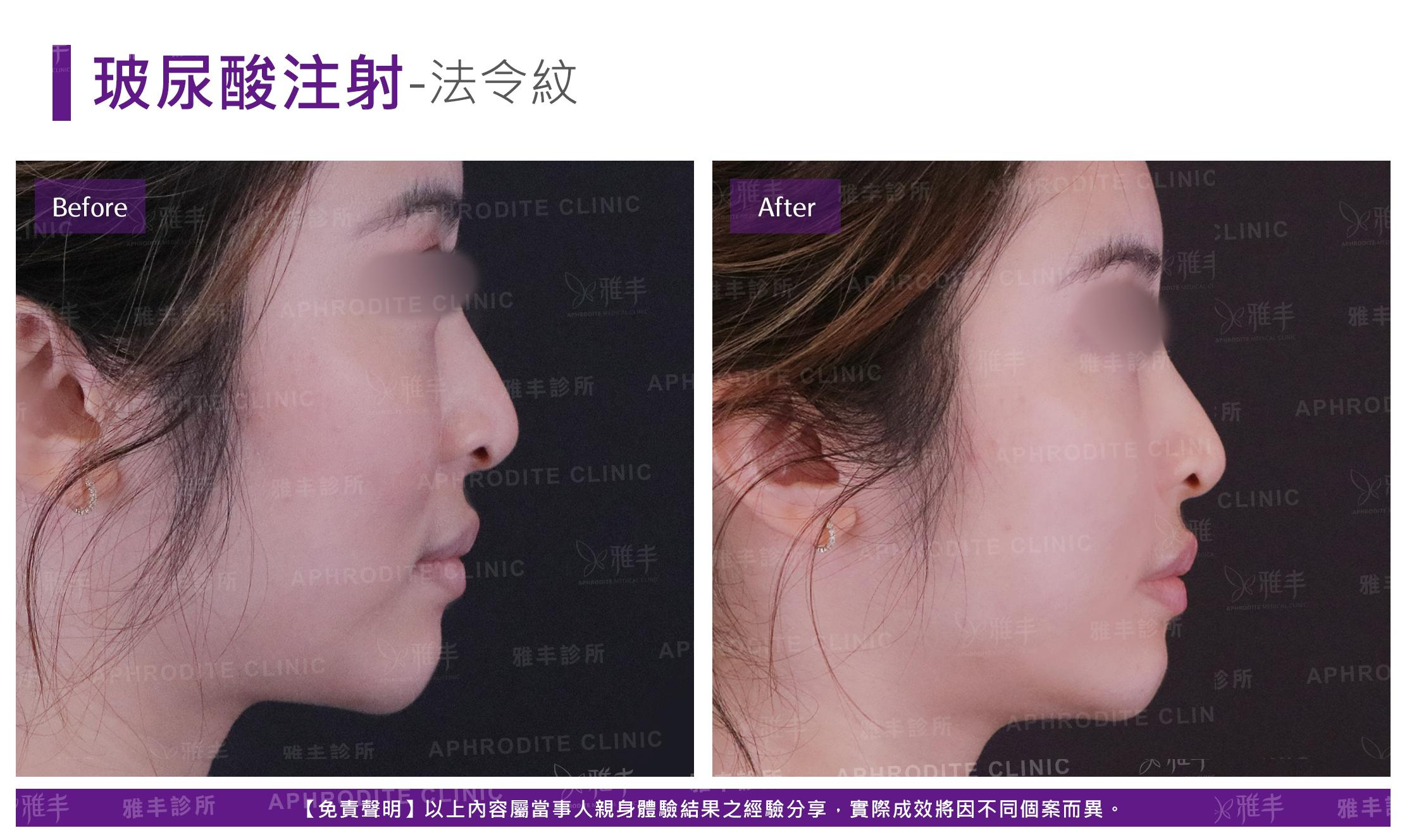 玻尿酸注射-case08-R90.jpg