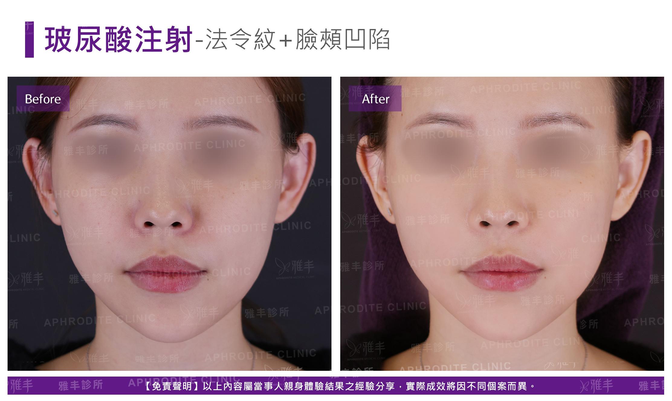 玻尿酸注射-case15-F.jpg