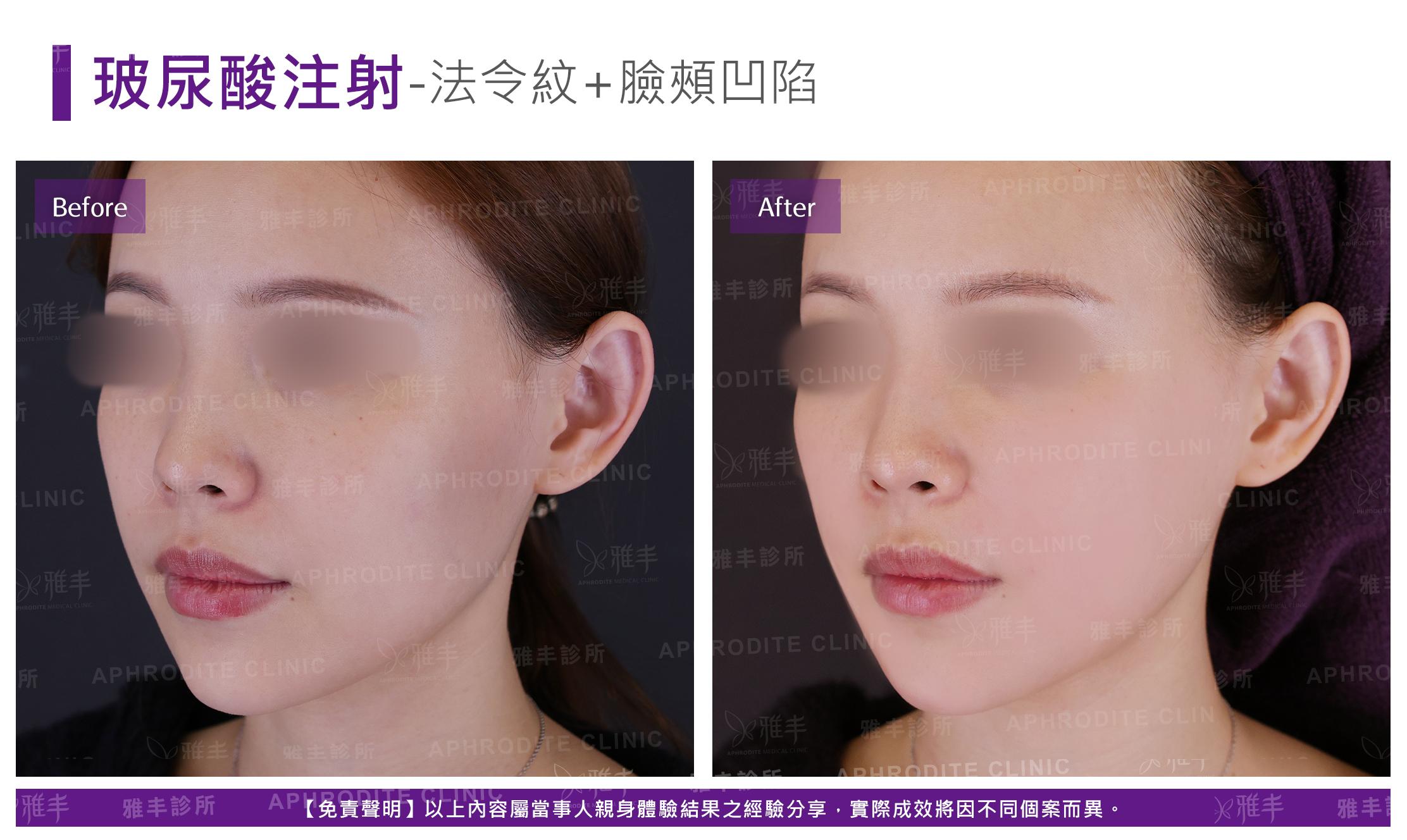 玻尿酸注射-case15-L45.jpg