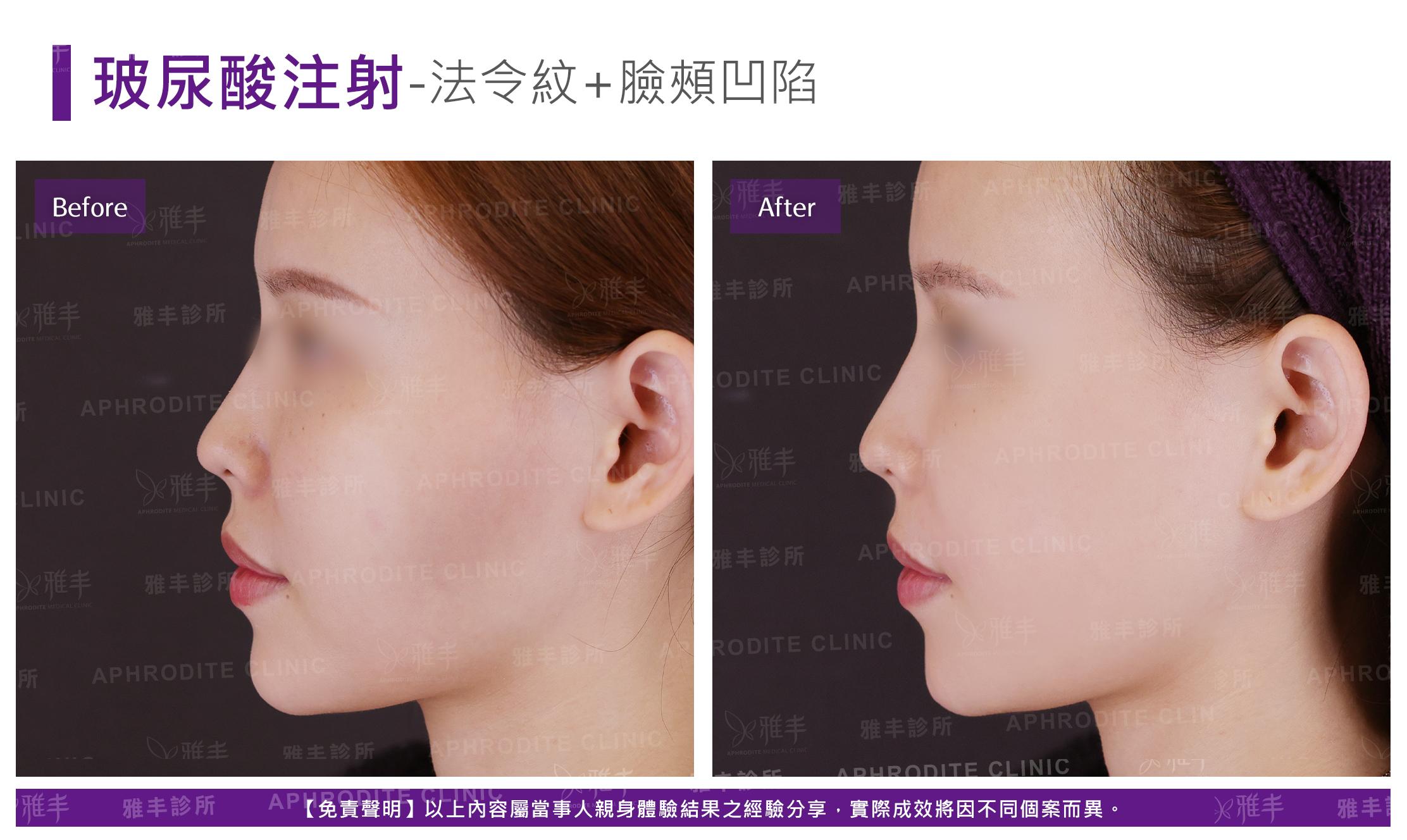 玻尿酸注射-case15-L90.jpg