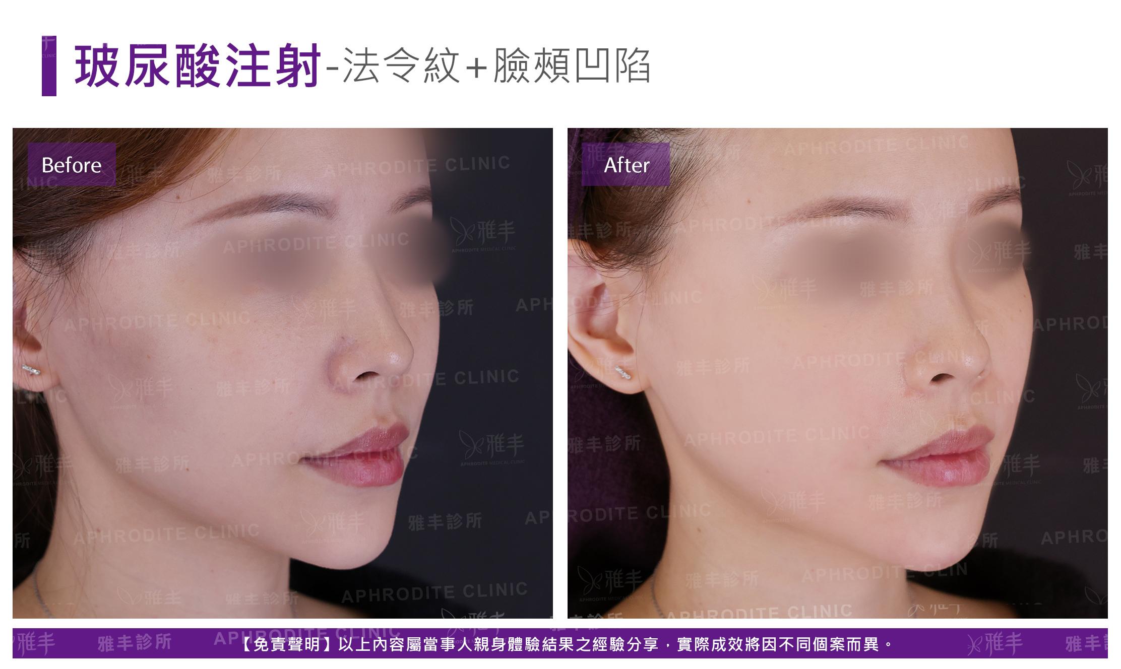 玻尿酸注射-case15-R45.jpg