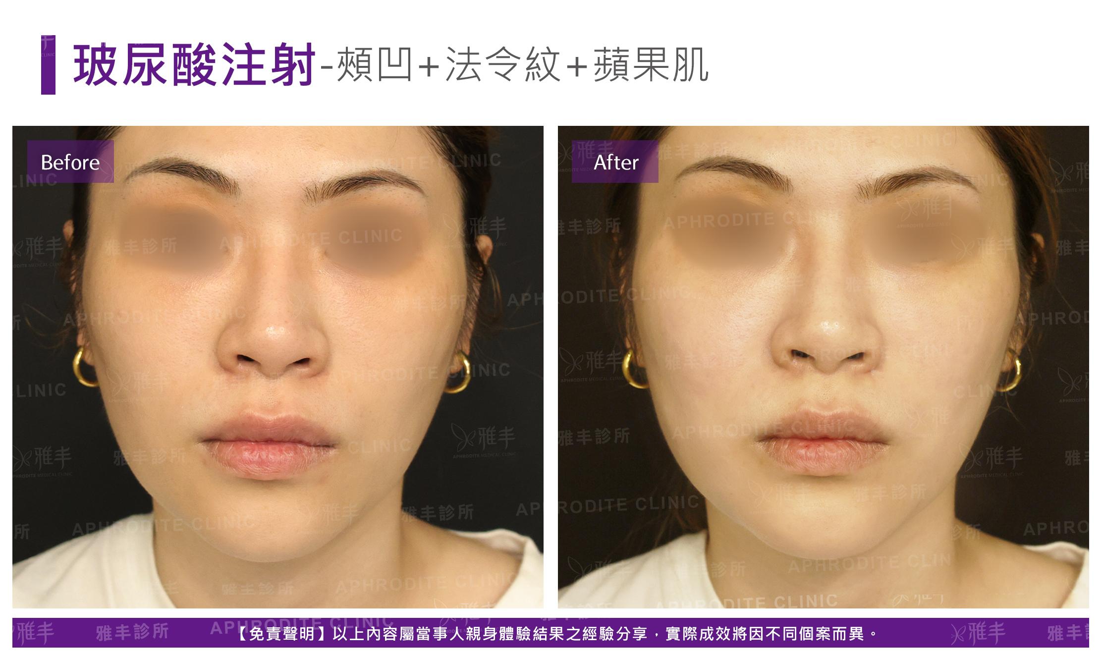 玻尿酸注射-case16-F.jpg