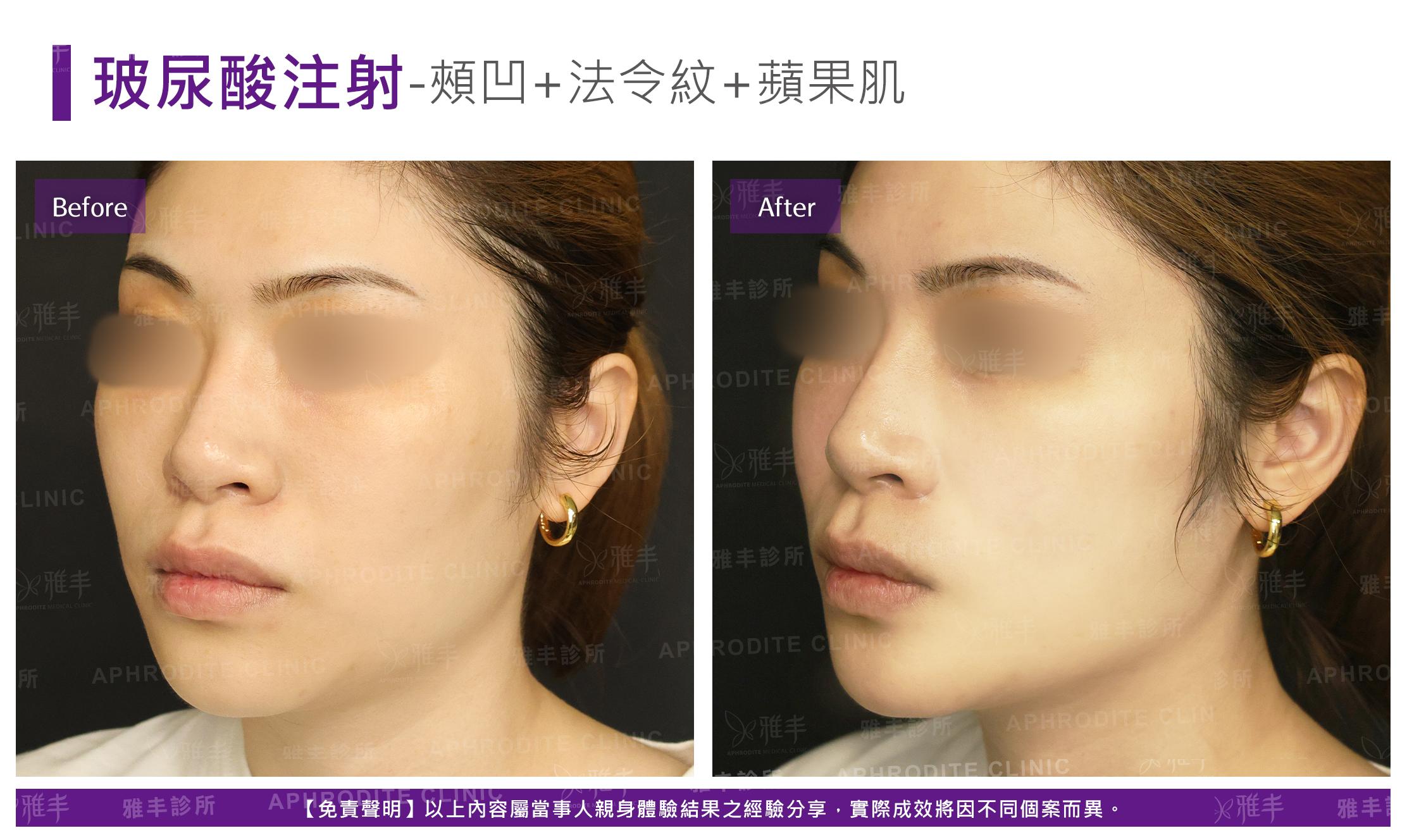 玻尿酸注射-case16-L45.jpg