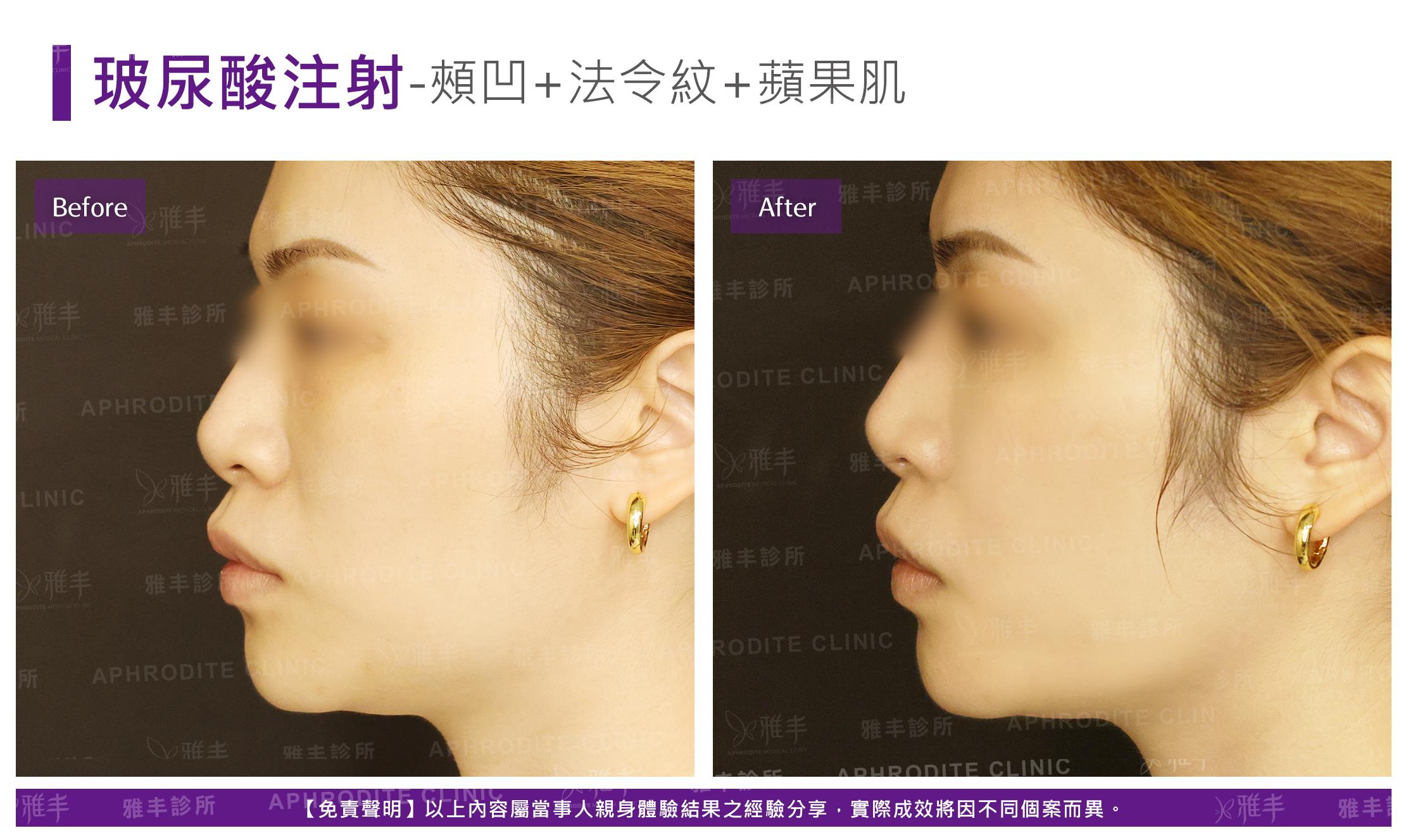 玻尿酸注射-case16-L90.jpg