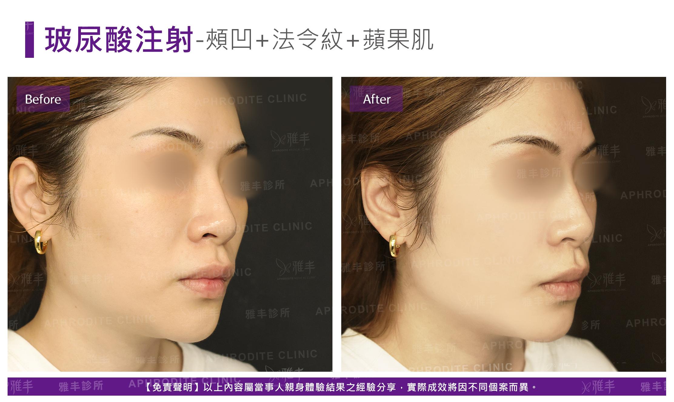 玻尿酸注射-case16-R45.jpg