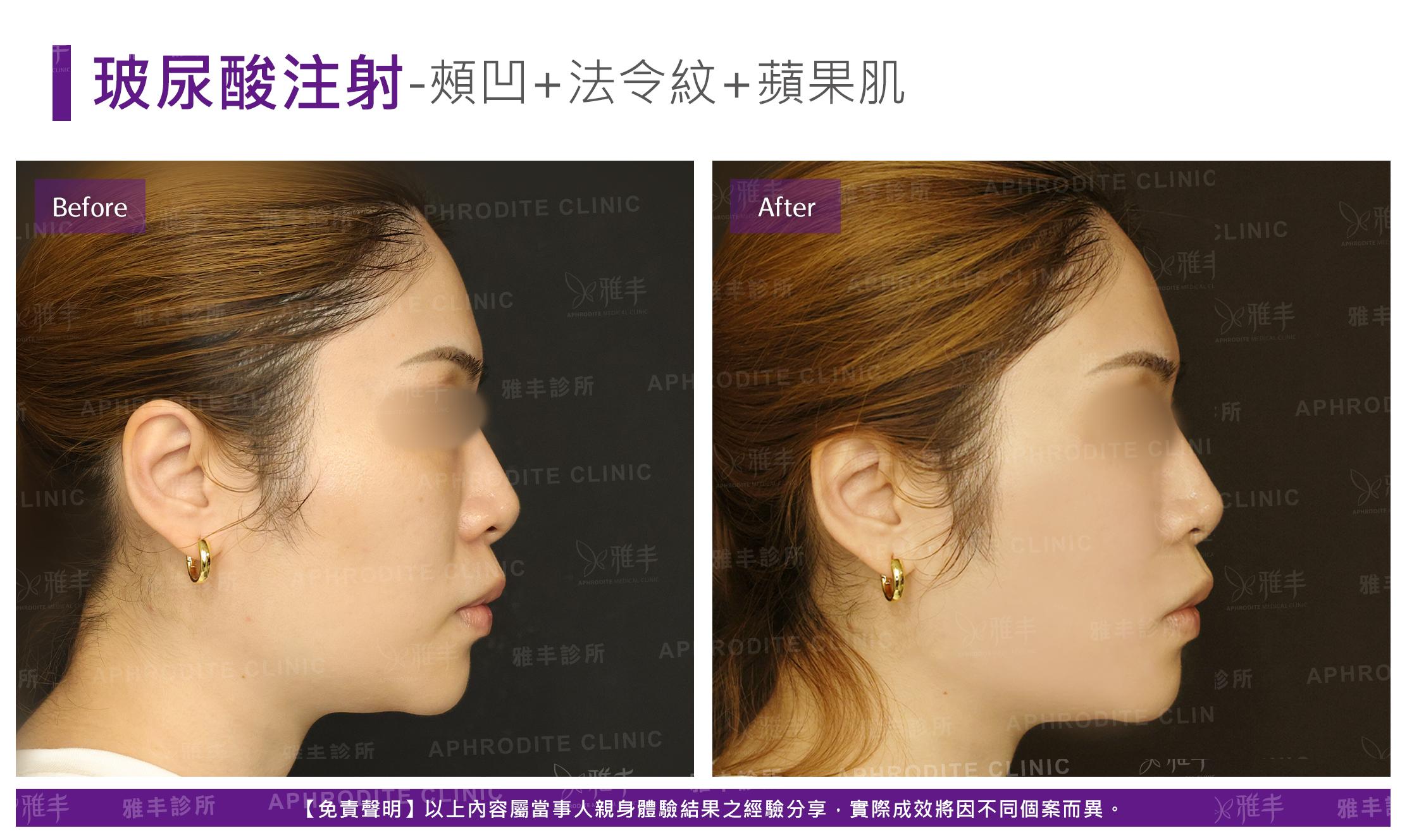 玻尿酸注射-case16-R90.jpg