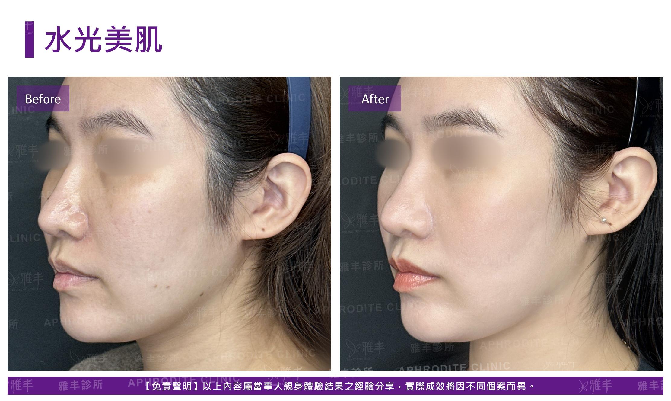 水光美肌-case2-L45.jpg