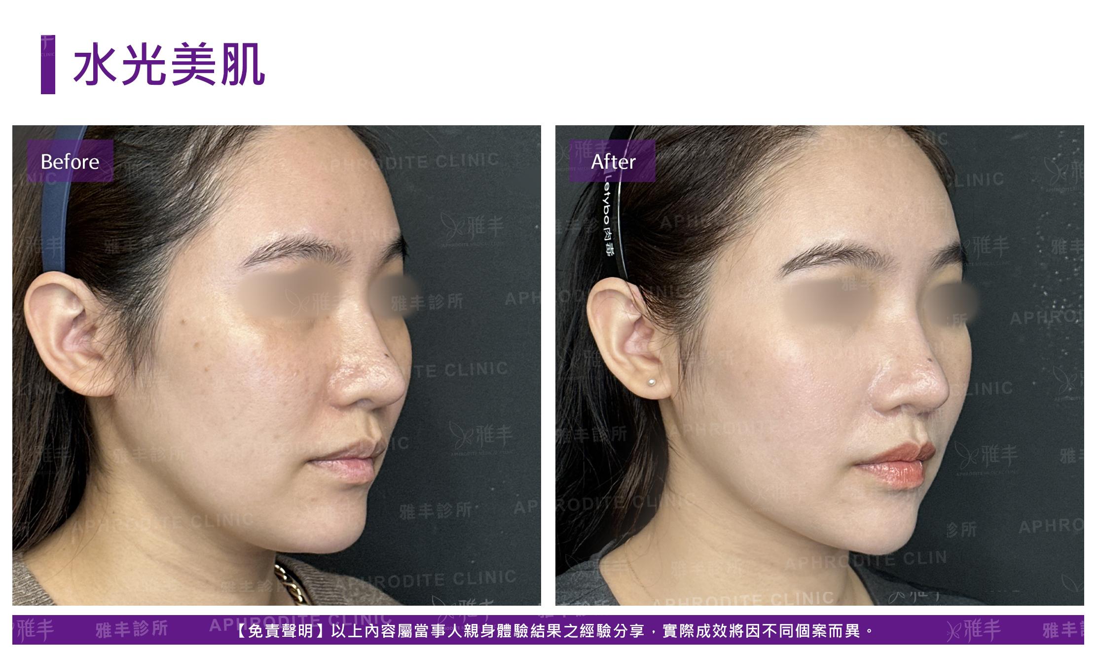 水光美肌-case2-R45.jpg