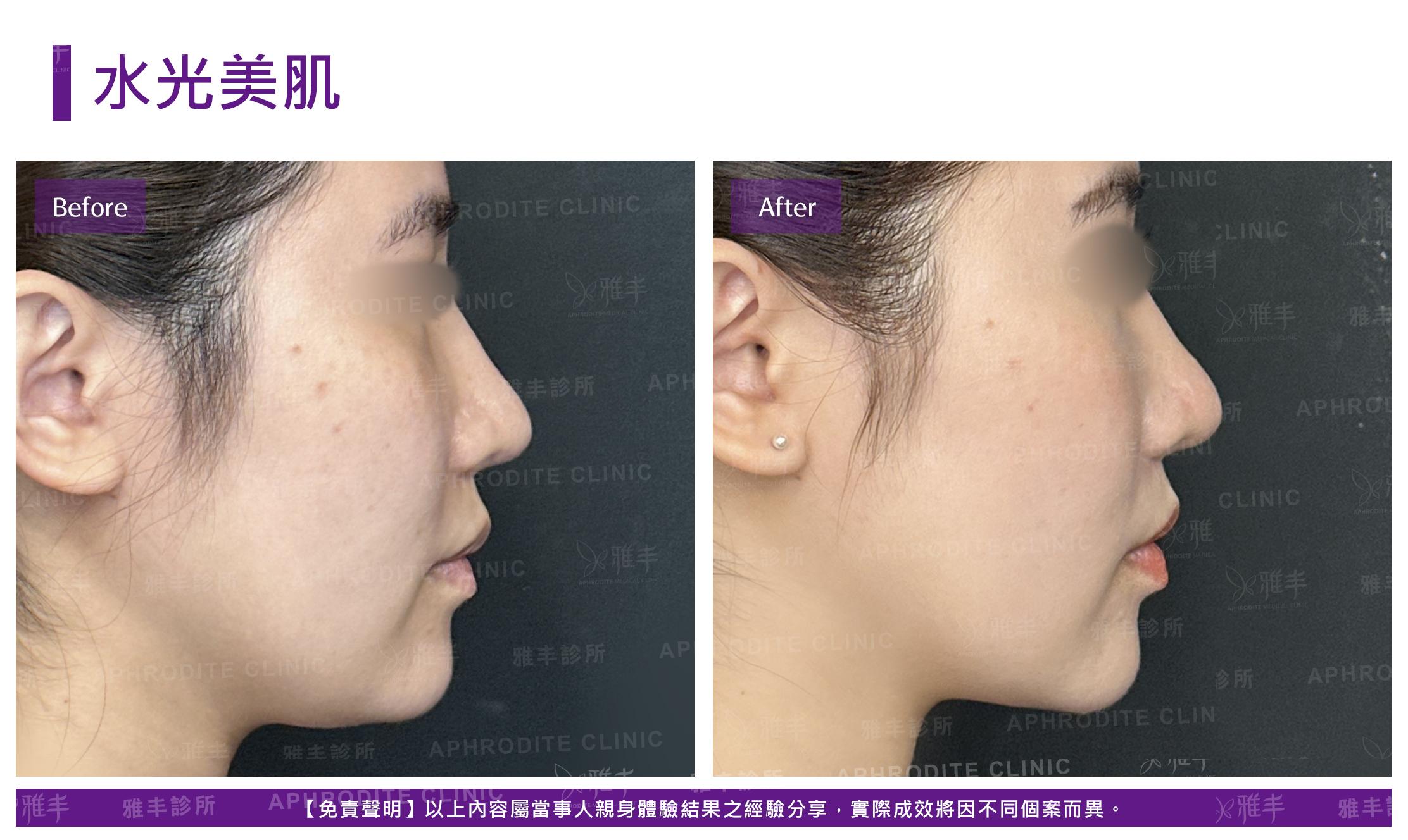 水光美肌-case2-R90.jpg