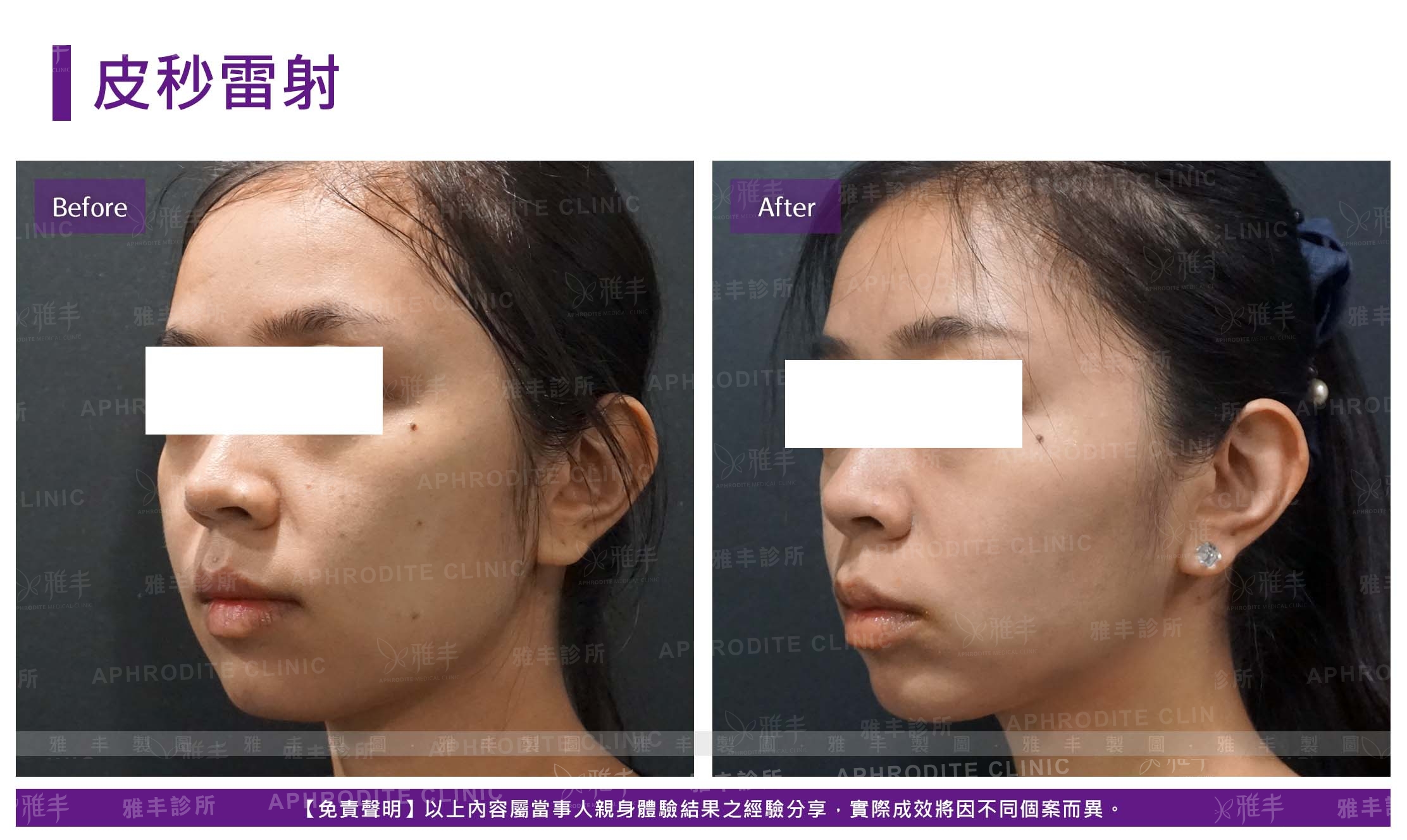 皮秒雷射case1-L45