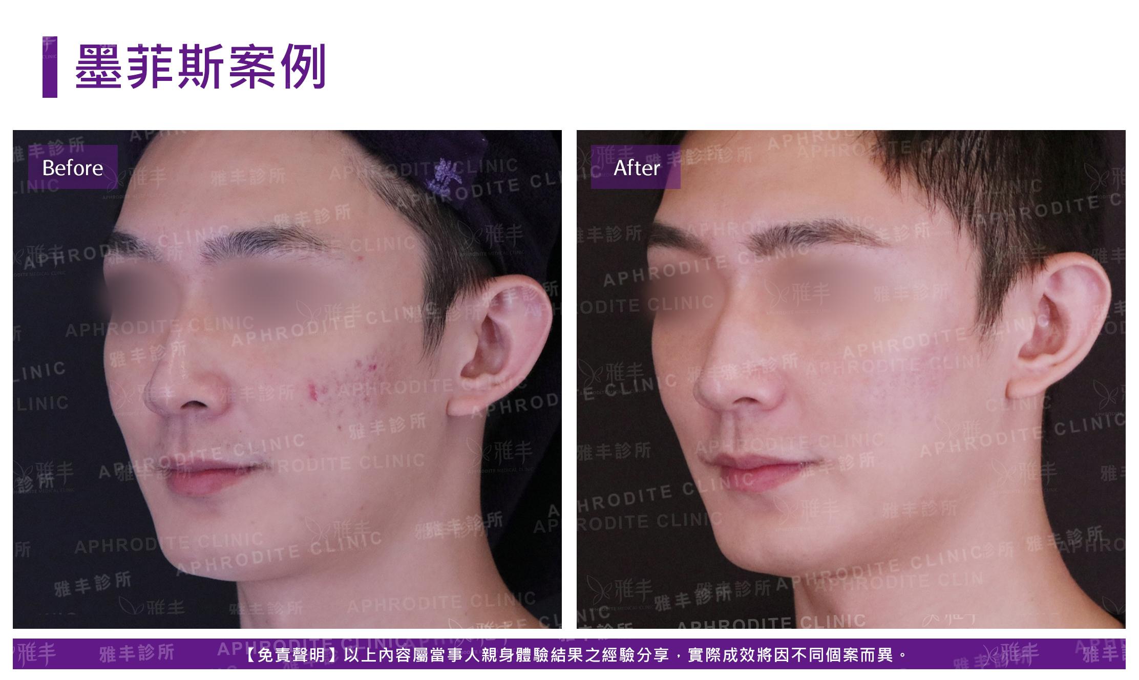 墨菲斯案例-case1-L45