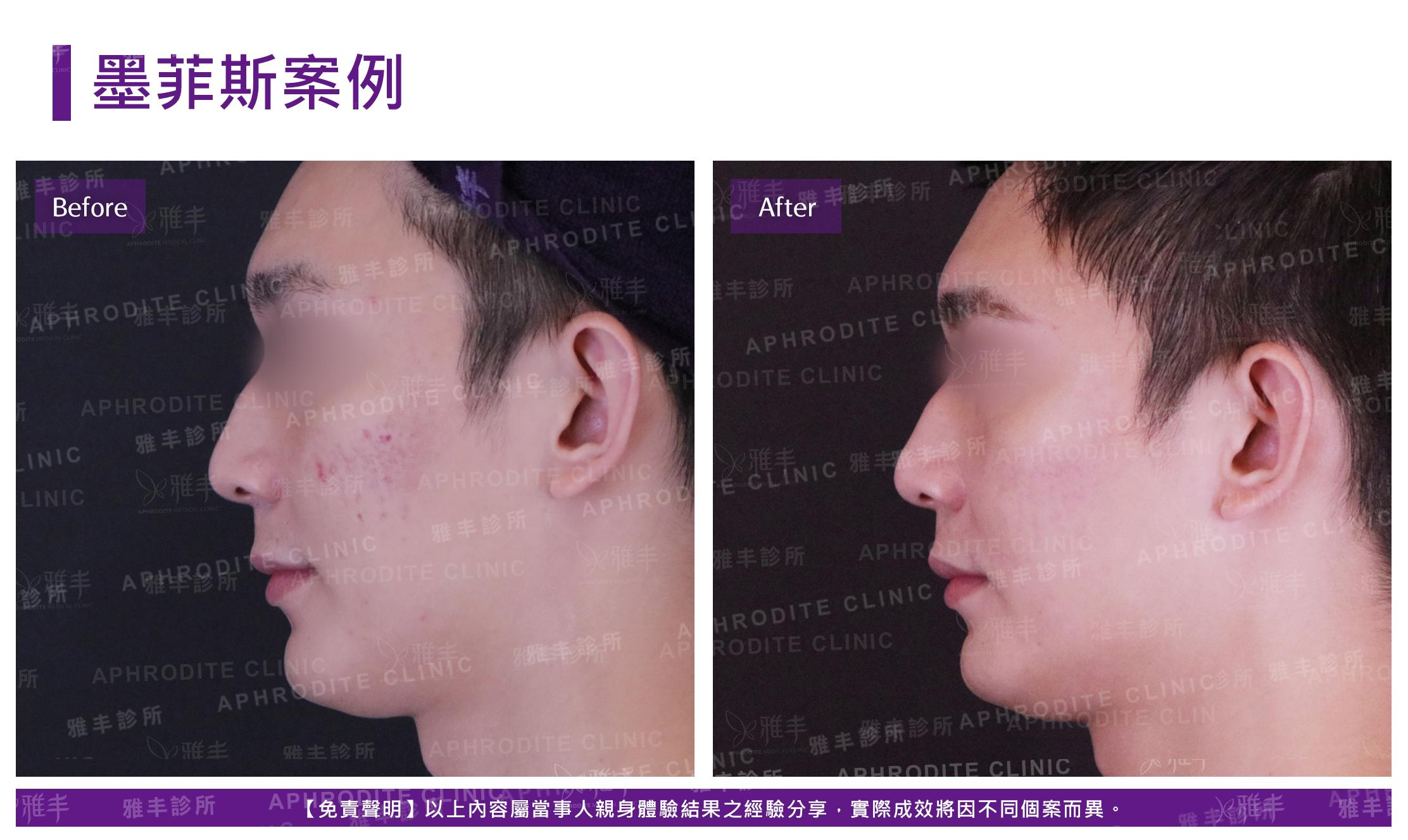 墨菲斯案例-case1-L90