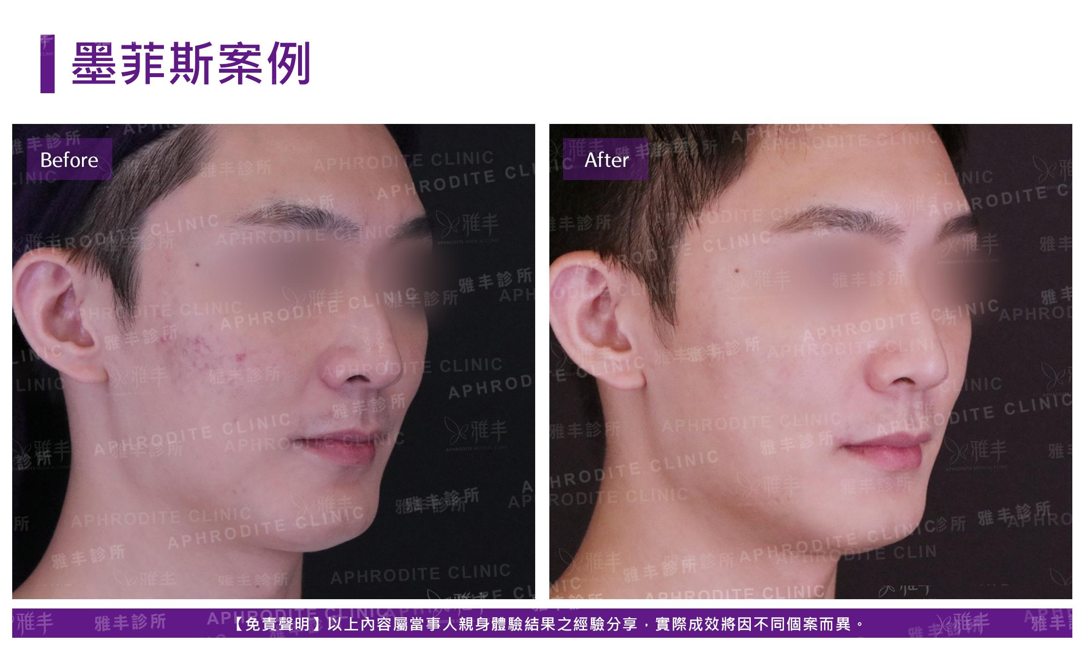 墨菲斯案例-case1-R45
