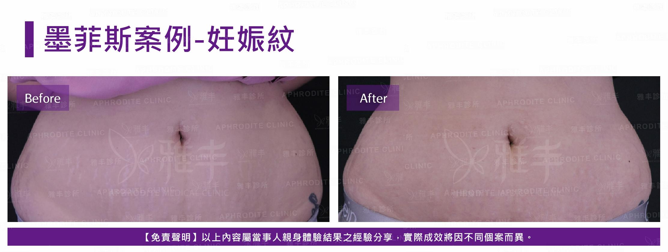 墨菲斯案例-case2-F