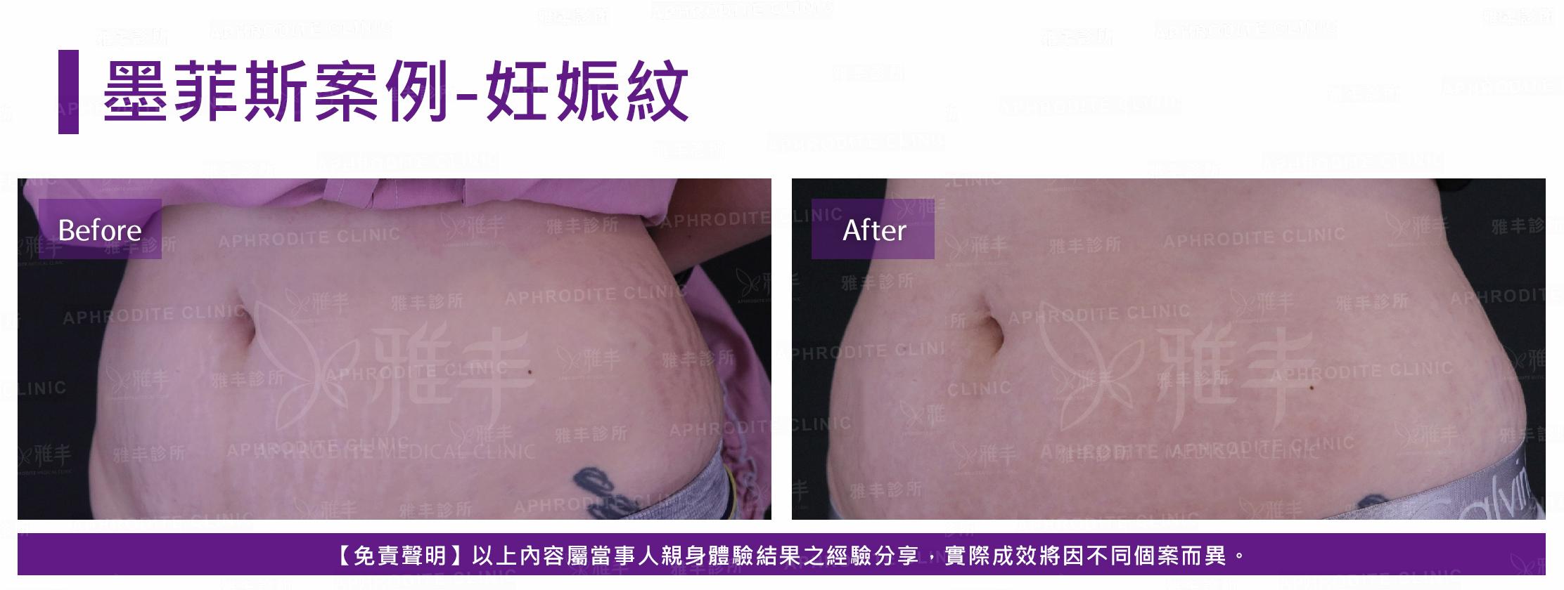 墨菲斯案例-case2-L45