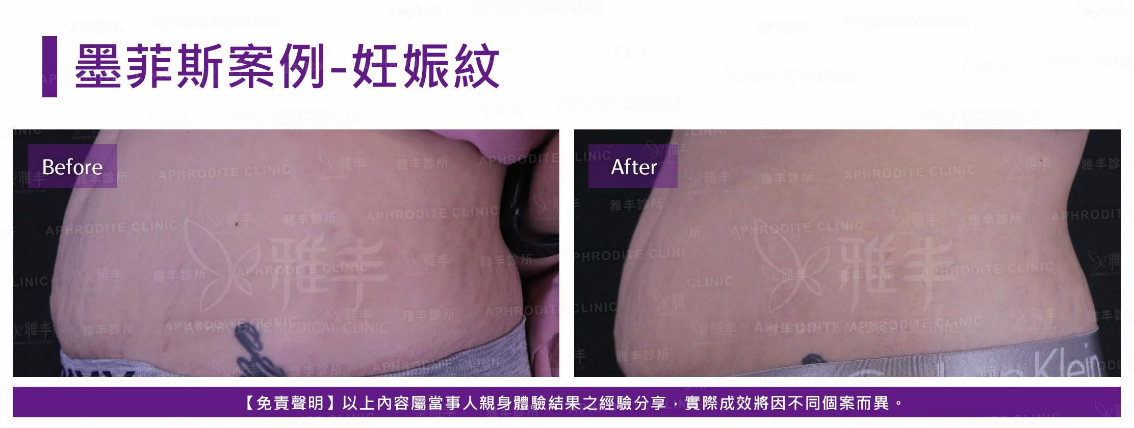 墨菲斯案例-case2-L90