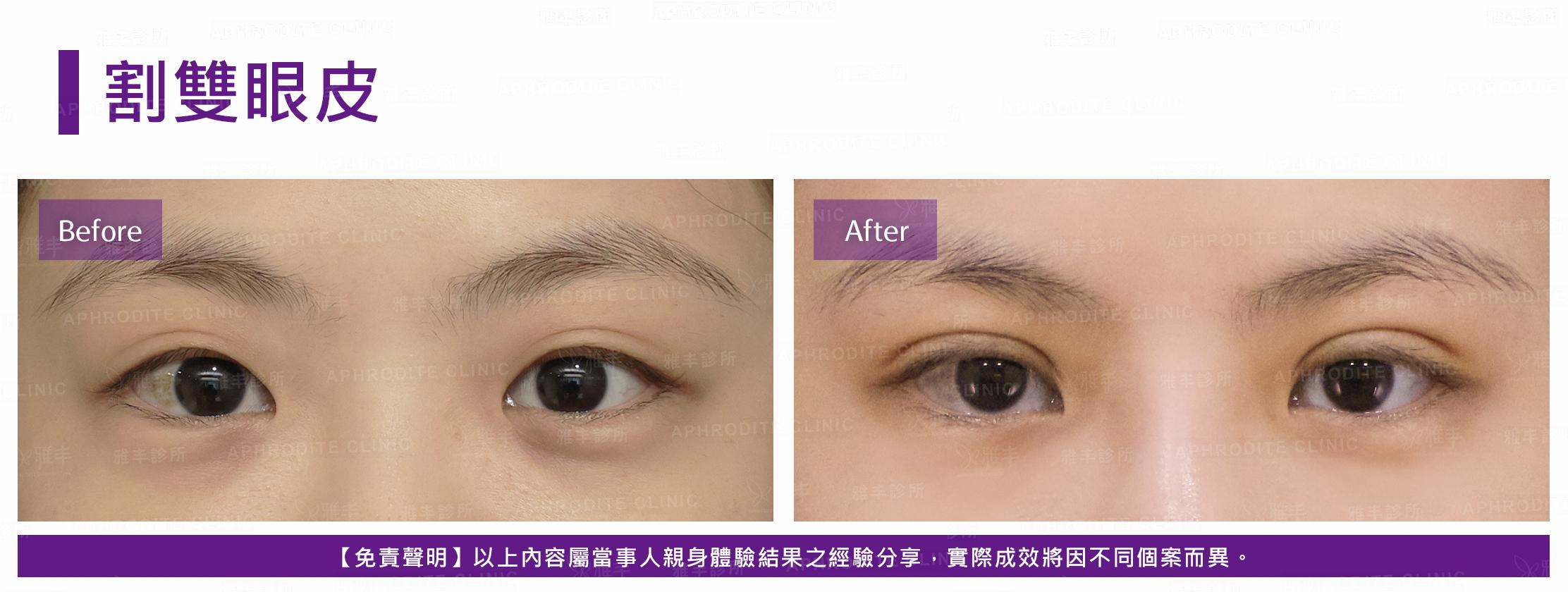 割雙眼皮-case10-F