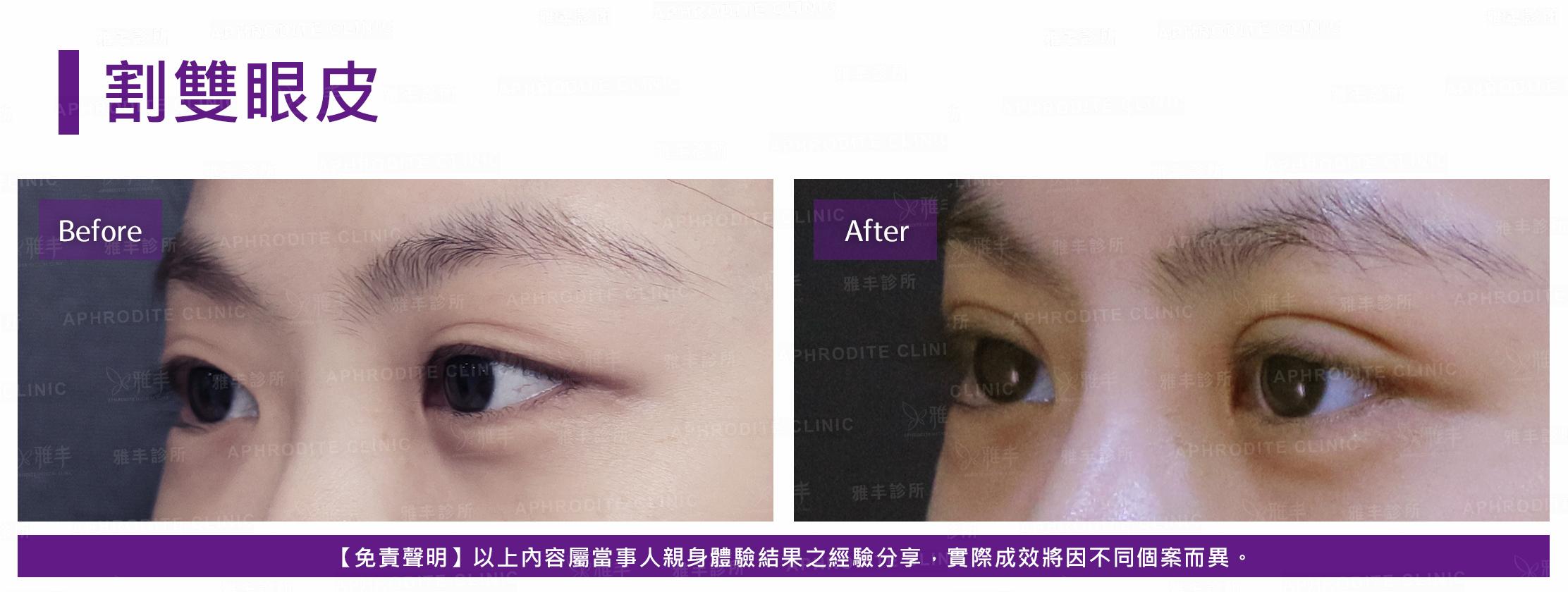 割雙眼皮-case10-L45.jpg