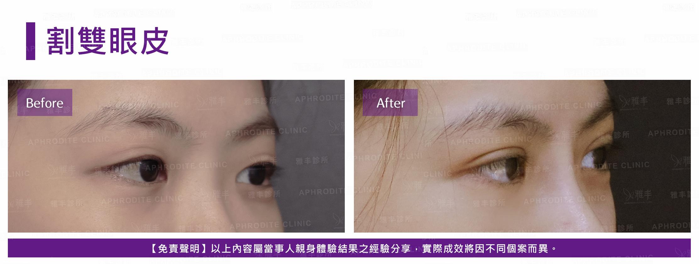割雙眼皮-case10-R45.jpg