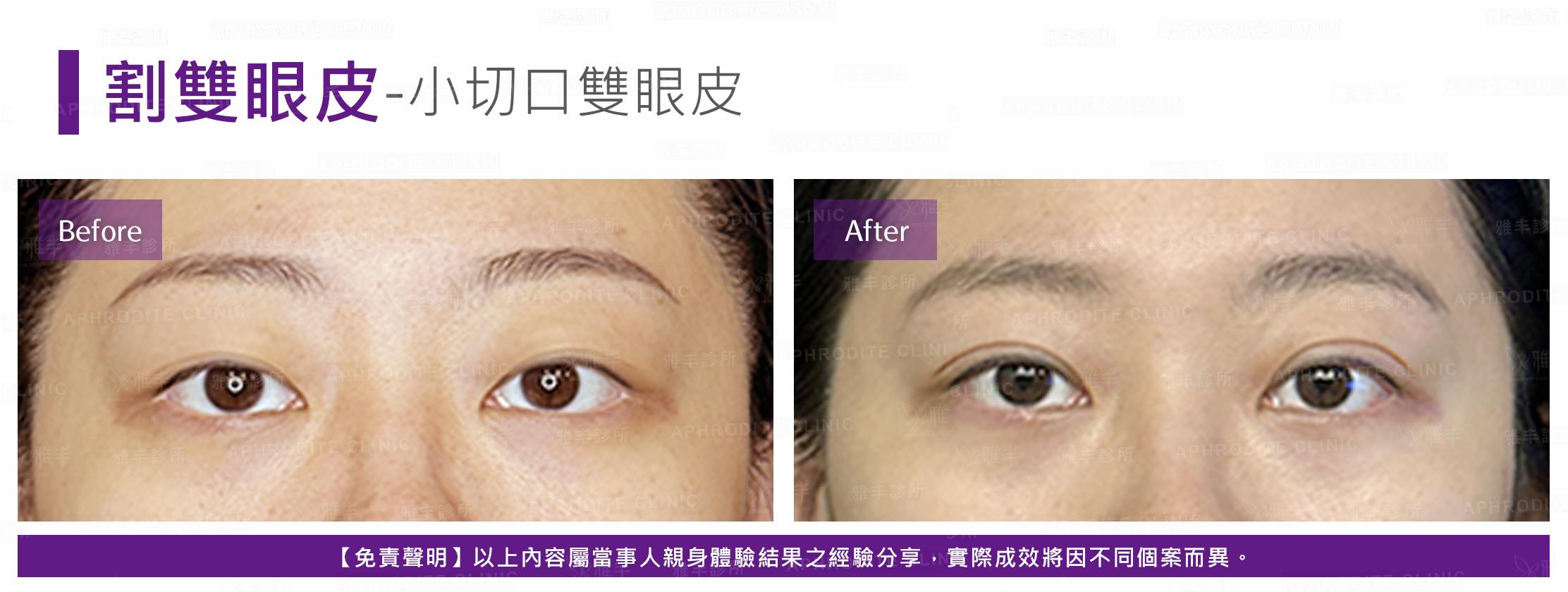 割雙眼皮-case11-F.jpg