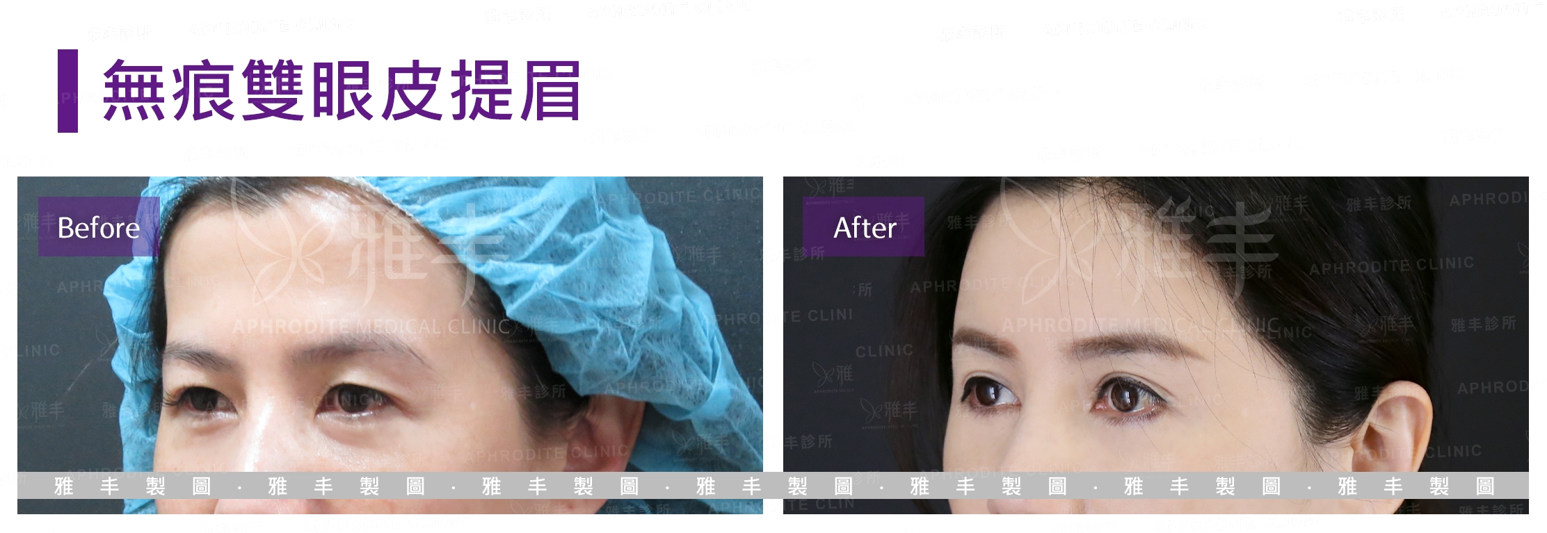 無痕雙眼皮提眉(Case2-L45)