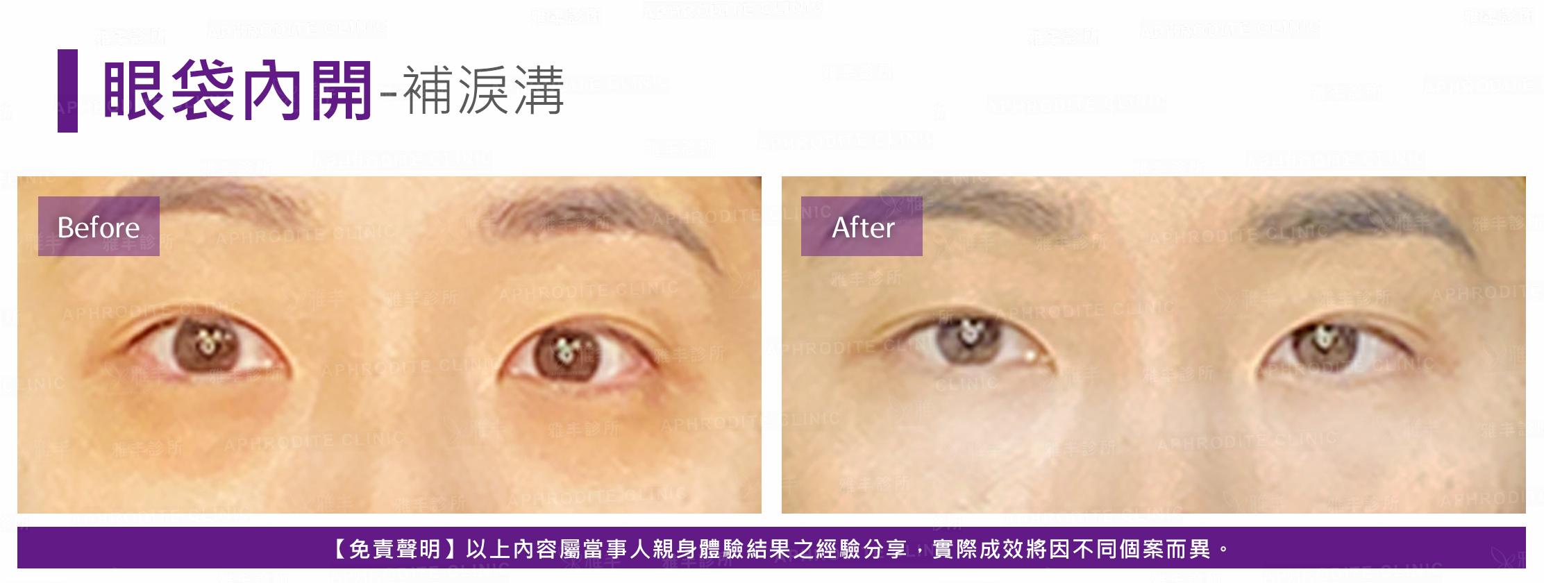 眼袋內開-case18-F.jpg