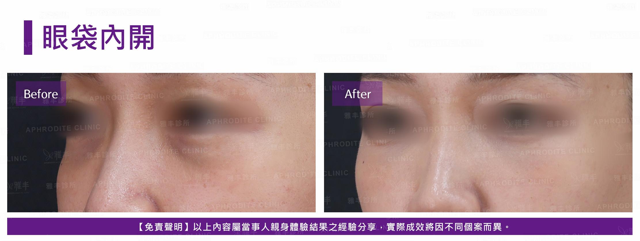 眼袋內開-case19-L45.jpg
