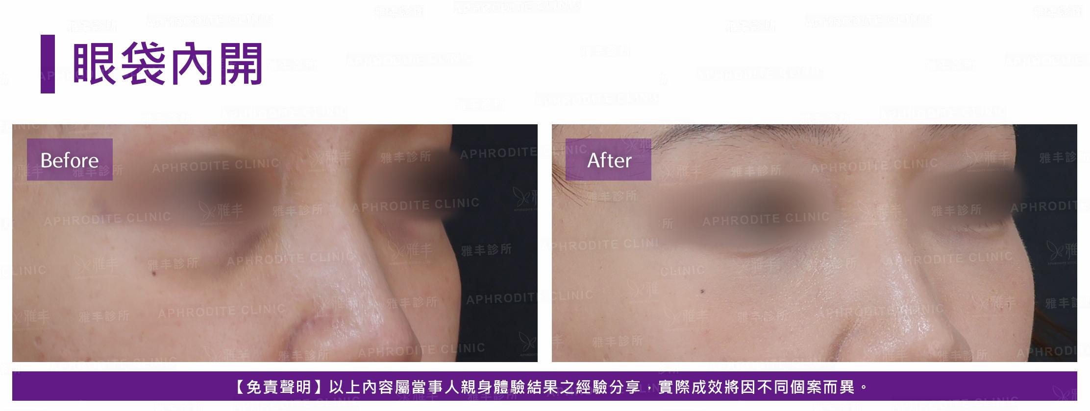 眼袋內開-case19-R45.jpg