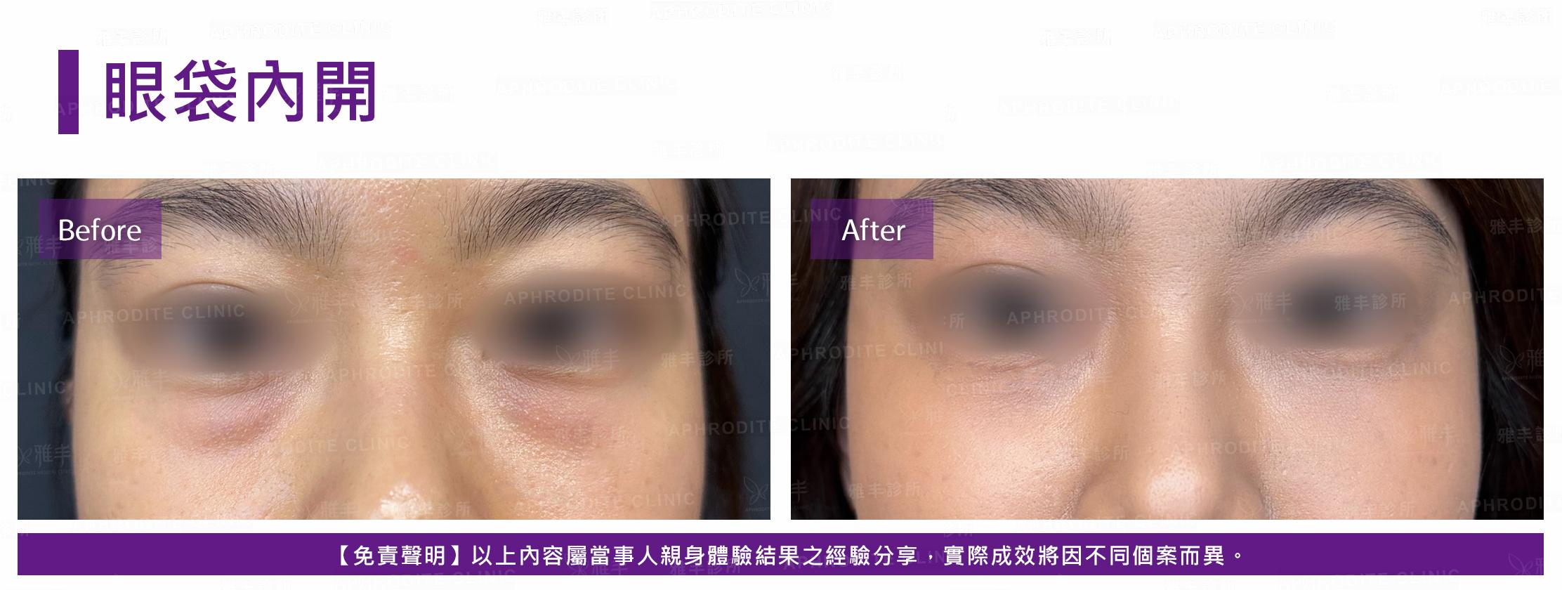 眼袋內開-case20-F.jpg