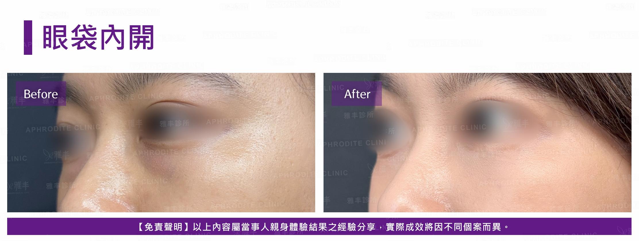 眼袋內開-case20-L45.jpg