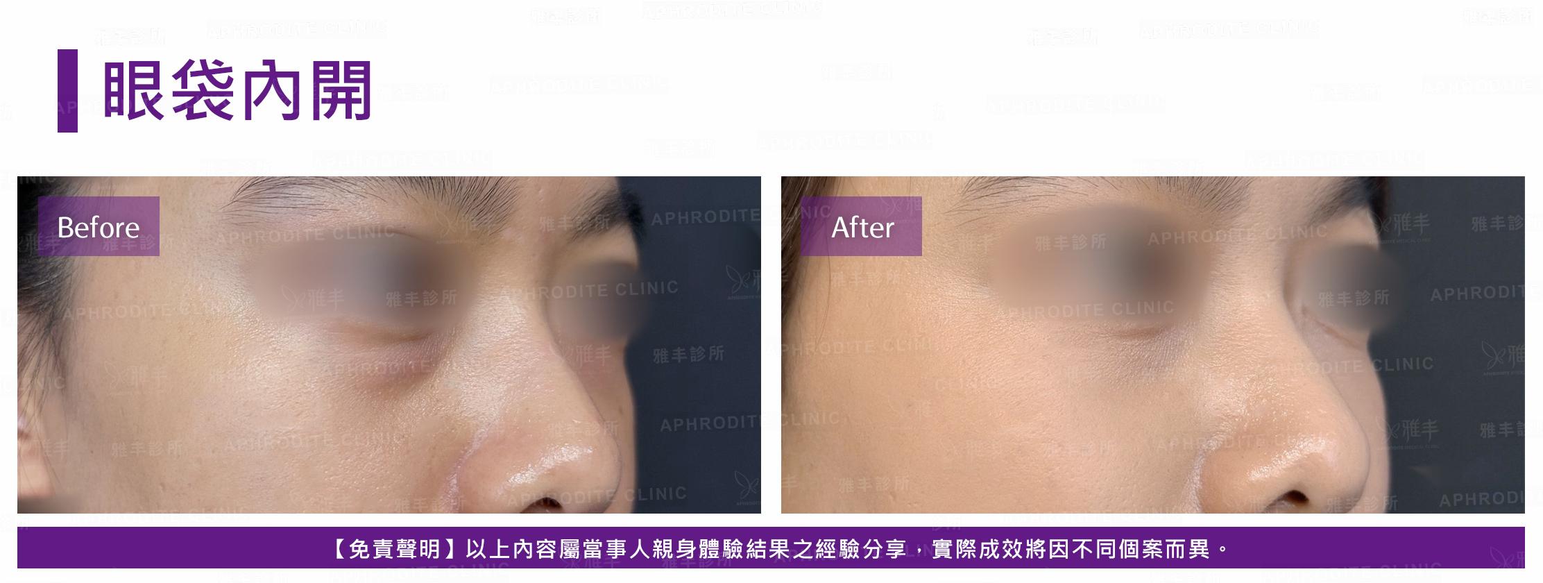 眼袋內開-case20-R45.jpg