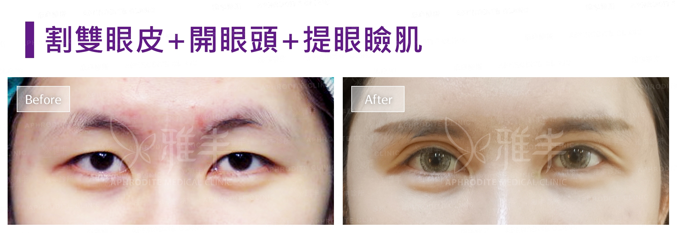 割雙眼皮+開眼頭+提眼瞼肌(Case10)