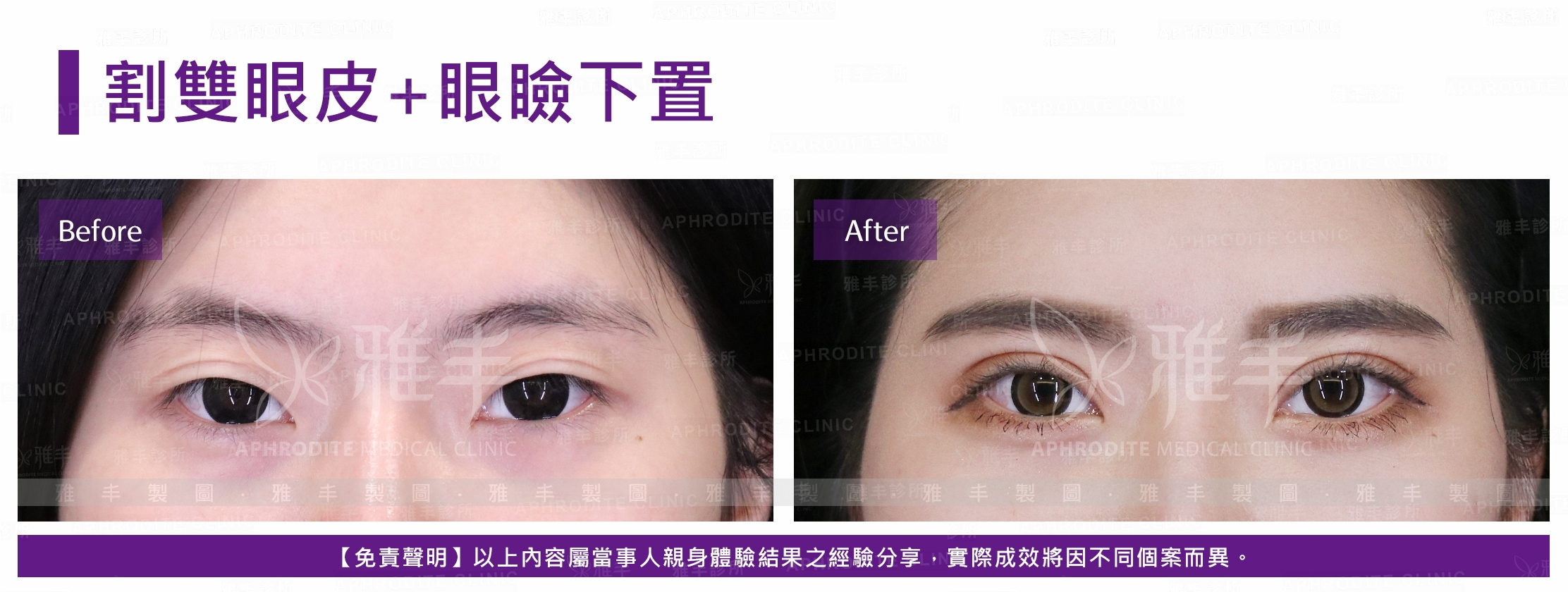 割雙眼皮+眼瞼下置(Case12)