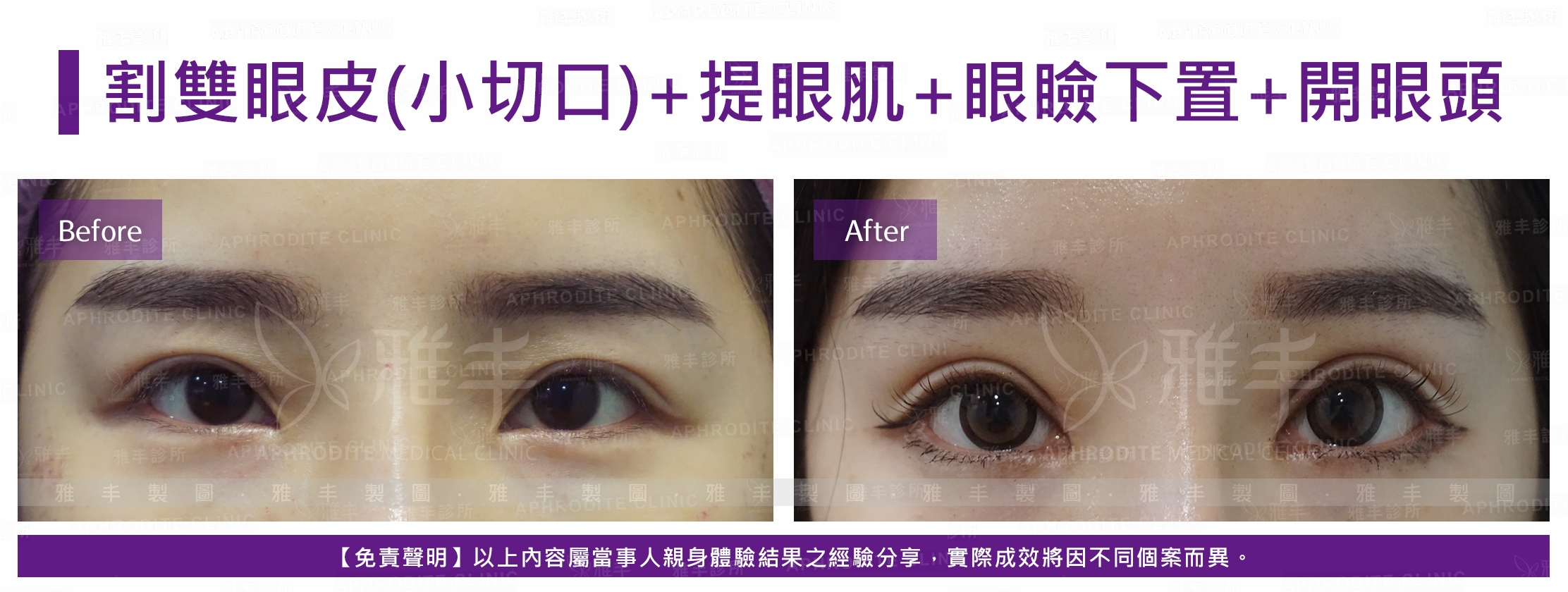 割雙眼皮(小切口)+提眼肌+眼瞼下置+開眼頭(Case13)