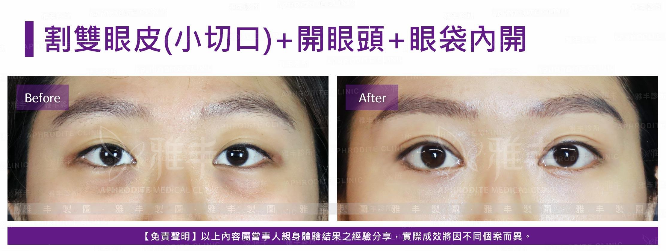 開眼頭+小切口+眼袋內開(Case16)