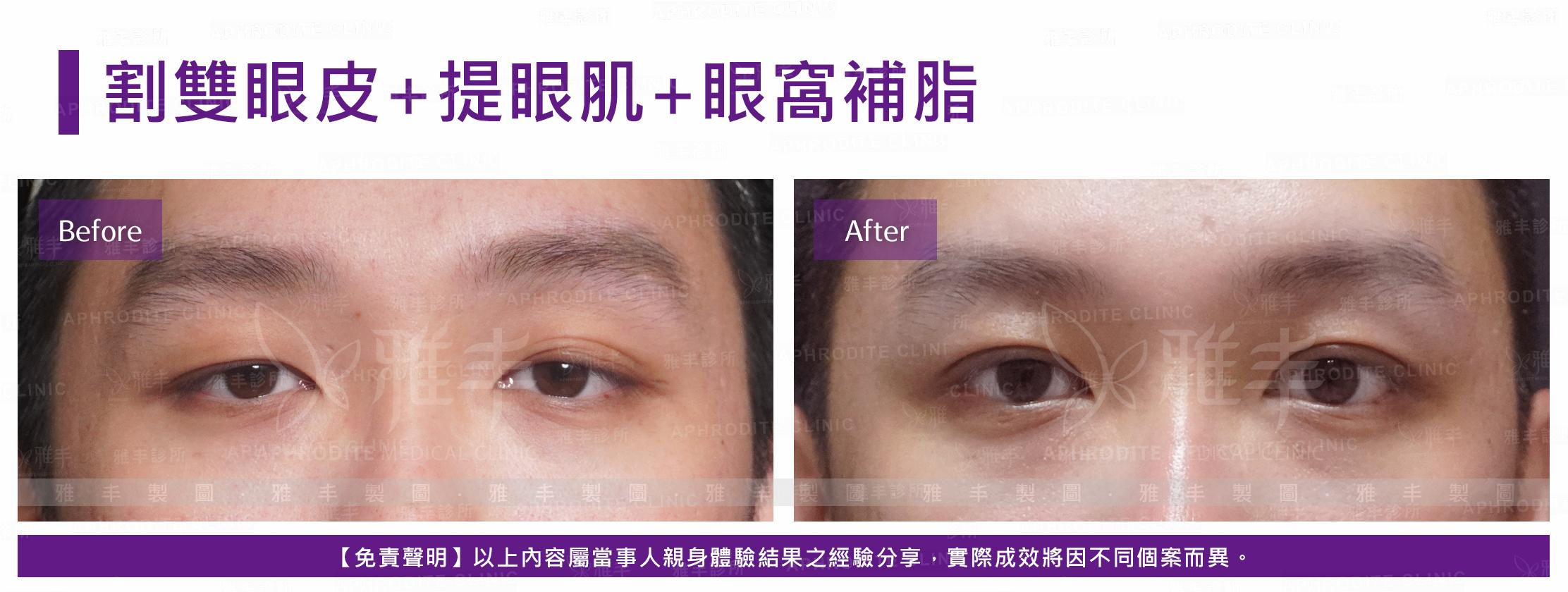 S-1-1-5-case19-F(割雙眼皮+提眼瞼肌+眼窩補脂).jpg