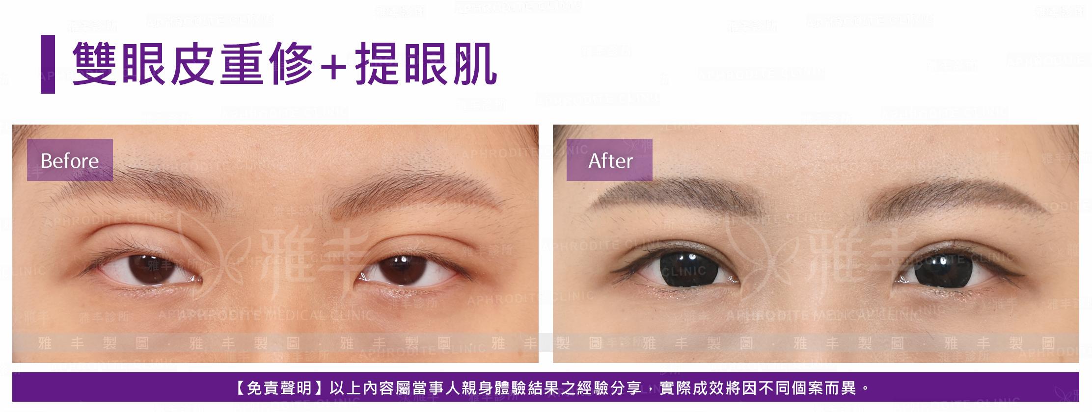 S-1-1-5-case20-F(雙眼皮重修+提眼肌).jpg