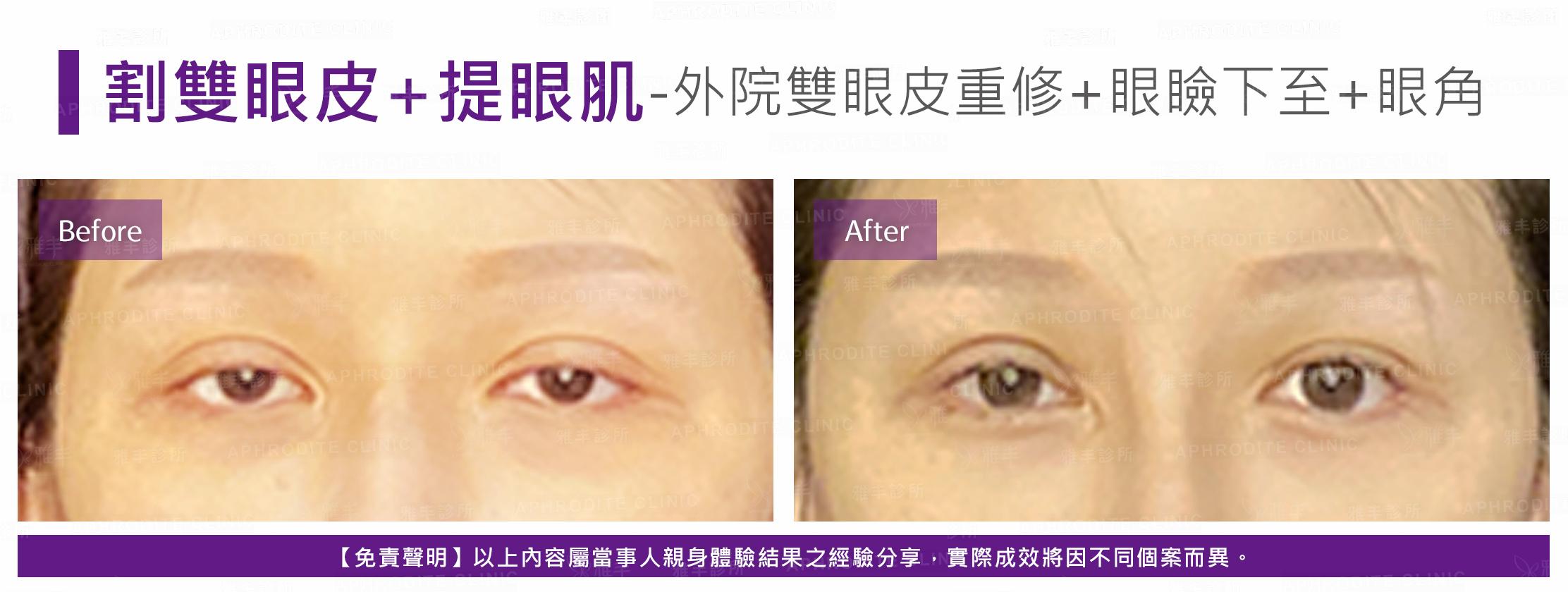 割雙眼皮-case22-F.jpg