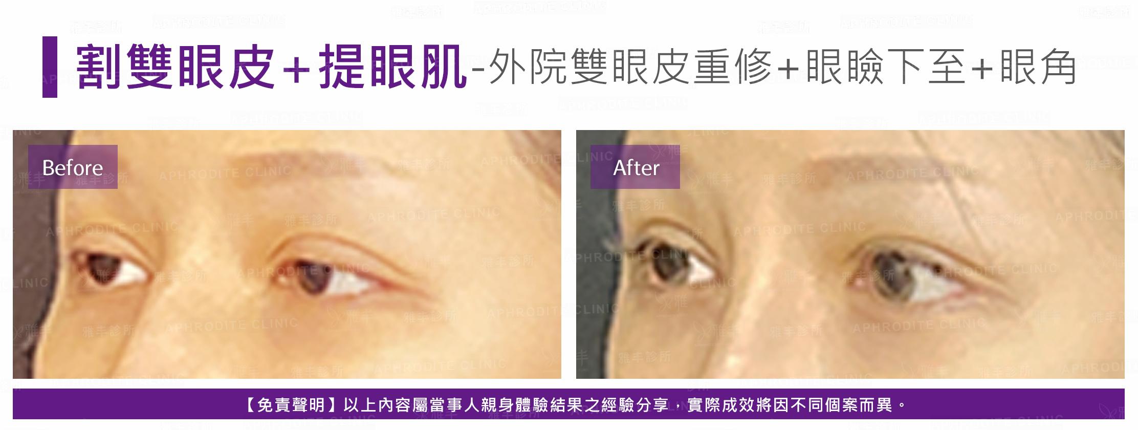 割雙眼皮-case22-L45.jpg