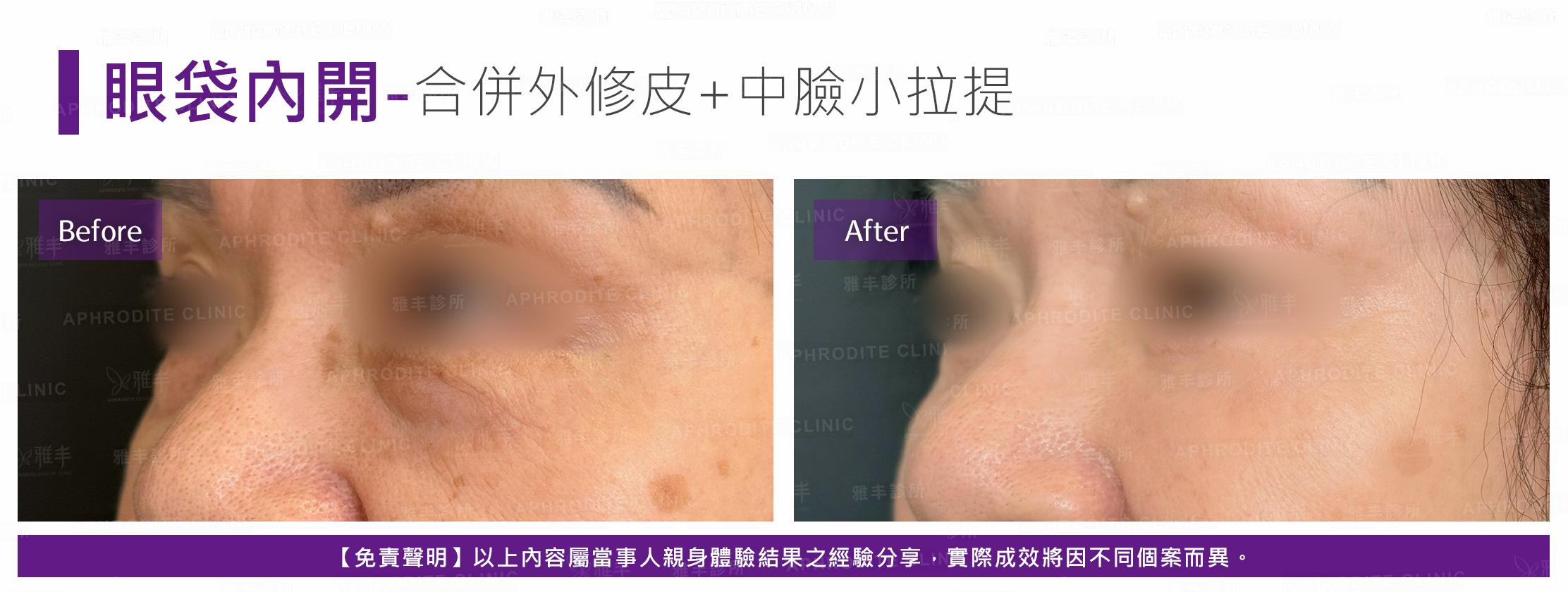 眼袋內開-case23-L45.jpg