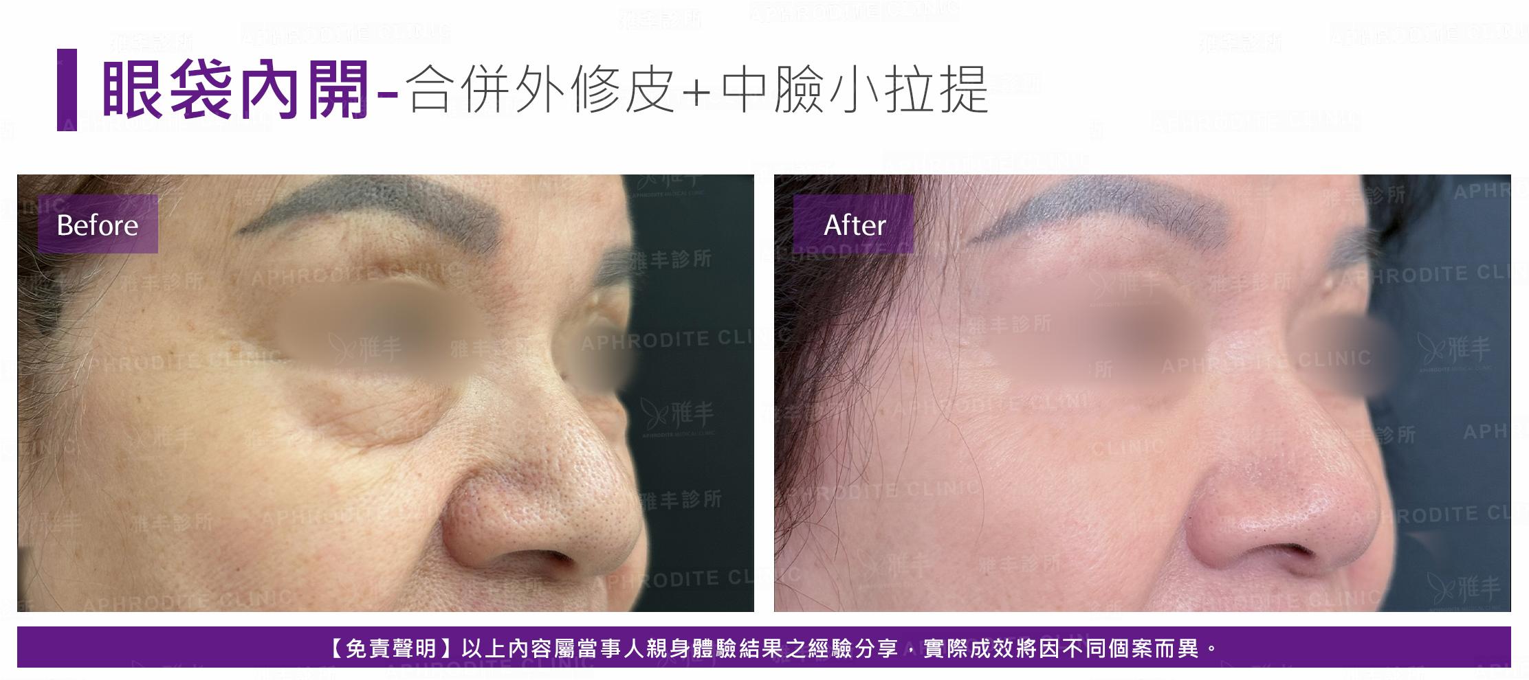 眼袋內開-case23-R45.jpg