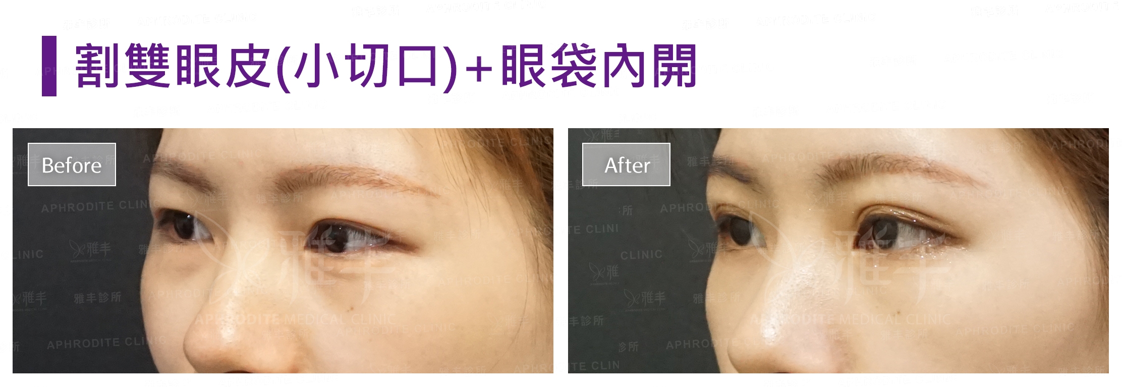 割雙眼皮-眼袋內開(Case3-L45)