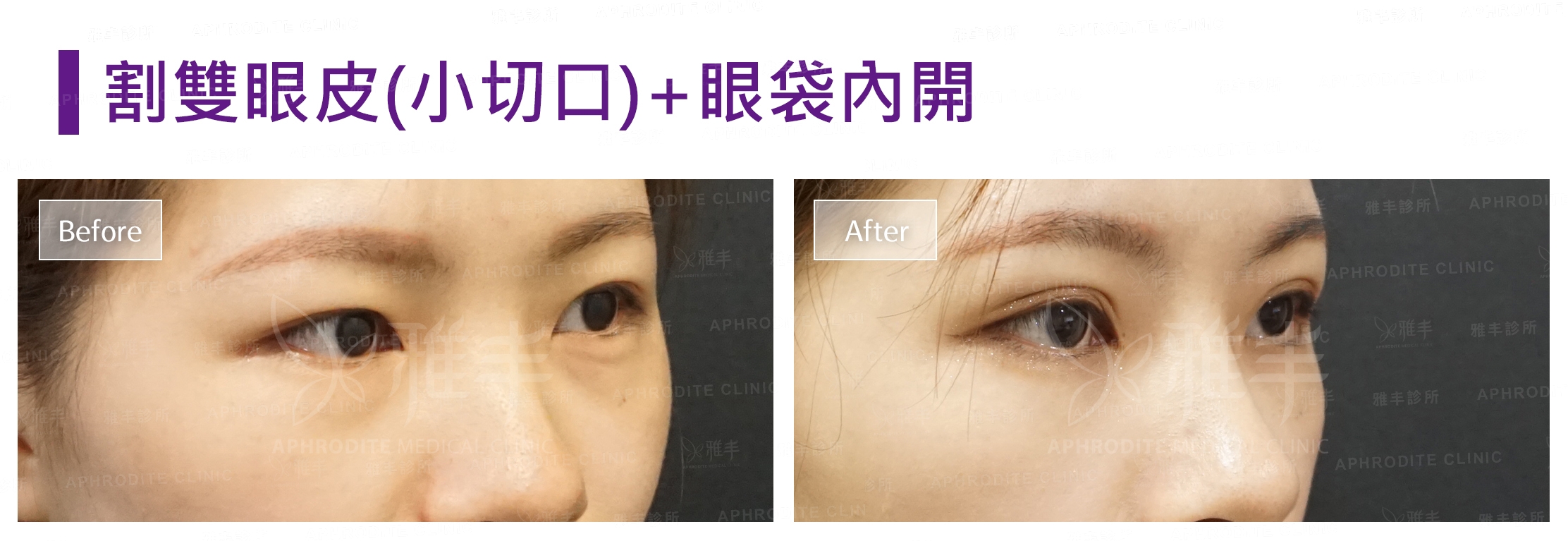 割雙眼皮-眼袋內開(Case3-R45)