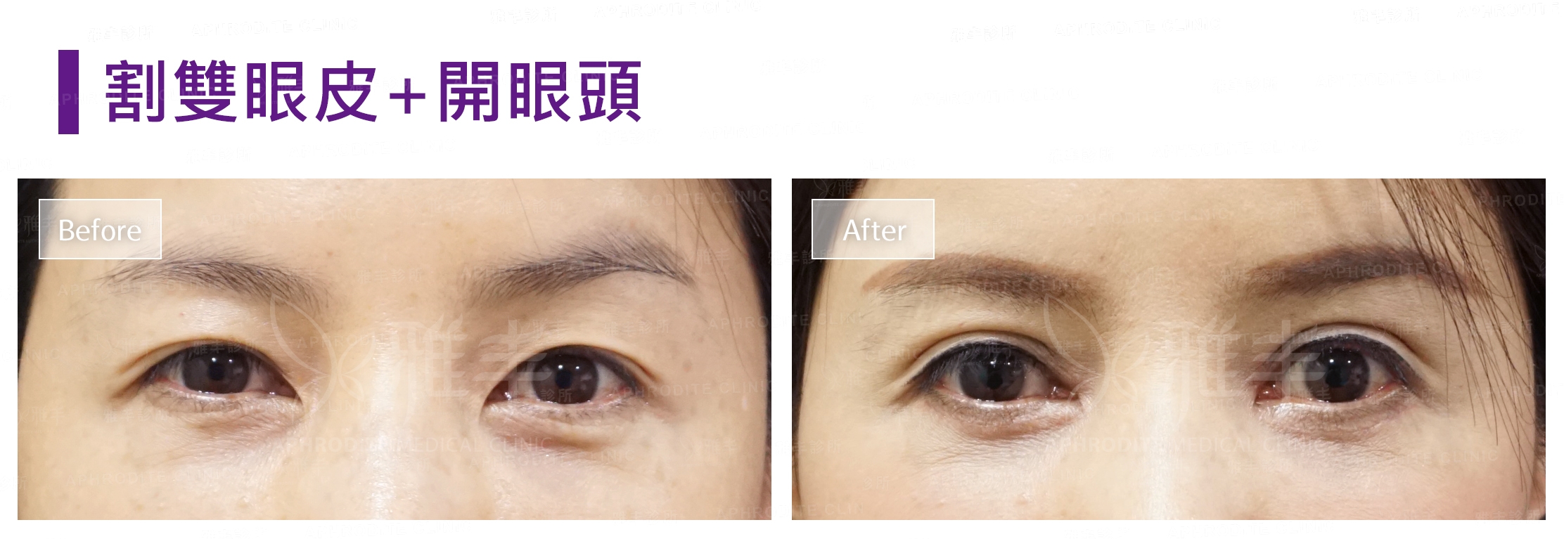 割雙眼皮+開眼頭(Case5)